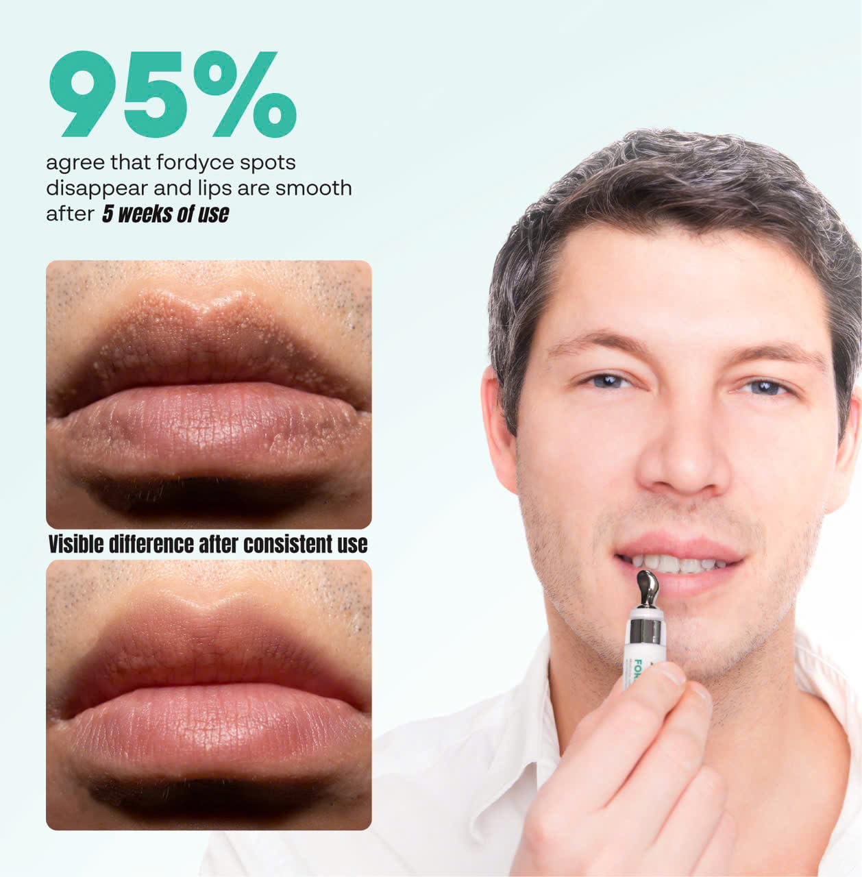 Abera Fordyce Cream - Advanced Formula with HPR (Next-Gen Retinoids), Fordyce Spot Remover For Lips, All-day Moisturizing, Help Improve Dry, Chapped Beauty and Personal Care ABERA