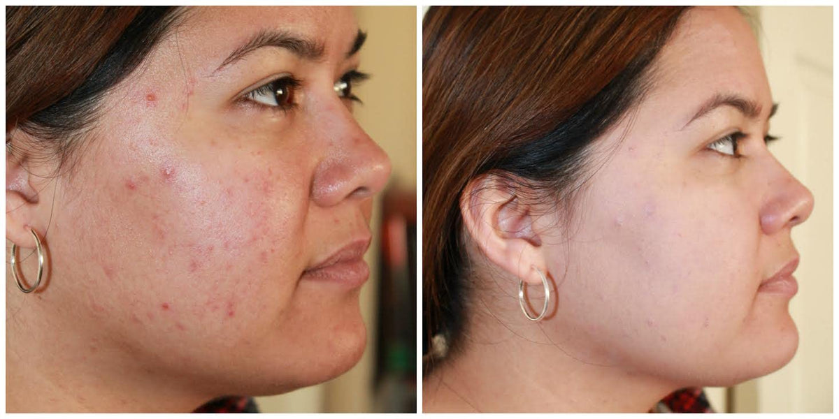 Judith August - EraseZit - Acne & Blemish Pencil (Neutral Light)