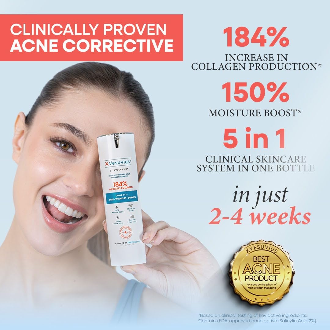 XVesuvius Acne Treatment Serum - Clinical Strength Formula with 2% Salicylic Acid & Retinol - Clears Breakouts, Fades Scars, Anti-Aging - 30ml (1 Beauty & Personal Care xvolcano