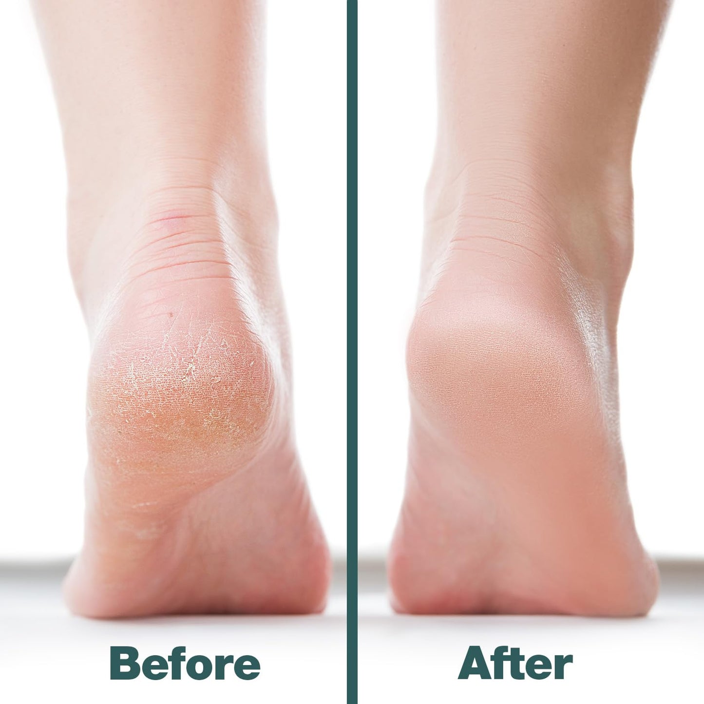 Probelle Double Sided Multidirectional Nickel Foot File Callus Remover - Immediately Reduces calluses and Corns to Powder for Instant Results, Safe Beauty & Personal Care Probelle