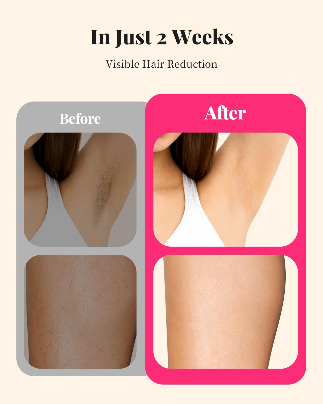 Laser Hair Removal for Women and Men, At-Home IPL Hair Removal Device with 5.2 cm² Treatment Window, Nearly Painless, Visible Results in 2 Weeks, Full Beauty and Personal Care LYSMOSKI