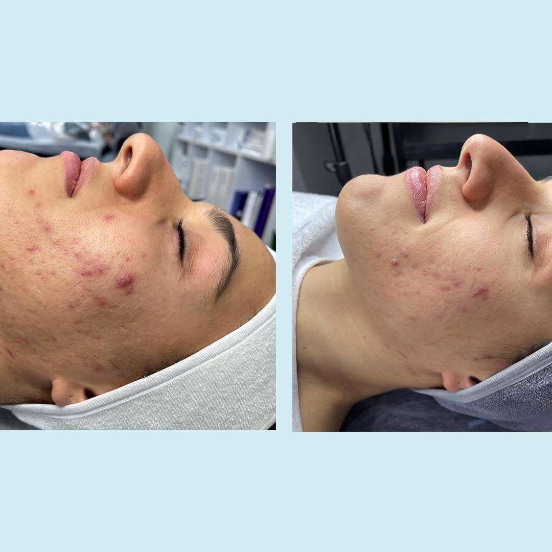 Salicylic Gel Chemical Peel - Enhanced with Green Tea Extract and Tea Tree Oil (20% Strength) Beauty & Personal Care Perfect Image