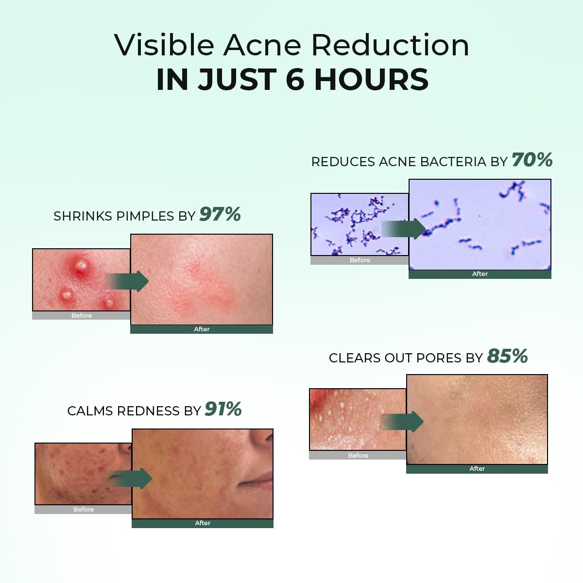 Acne Spot Corrector Gel Serum Beauty & Personal Care Conscious Chemist