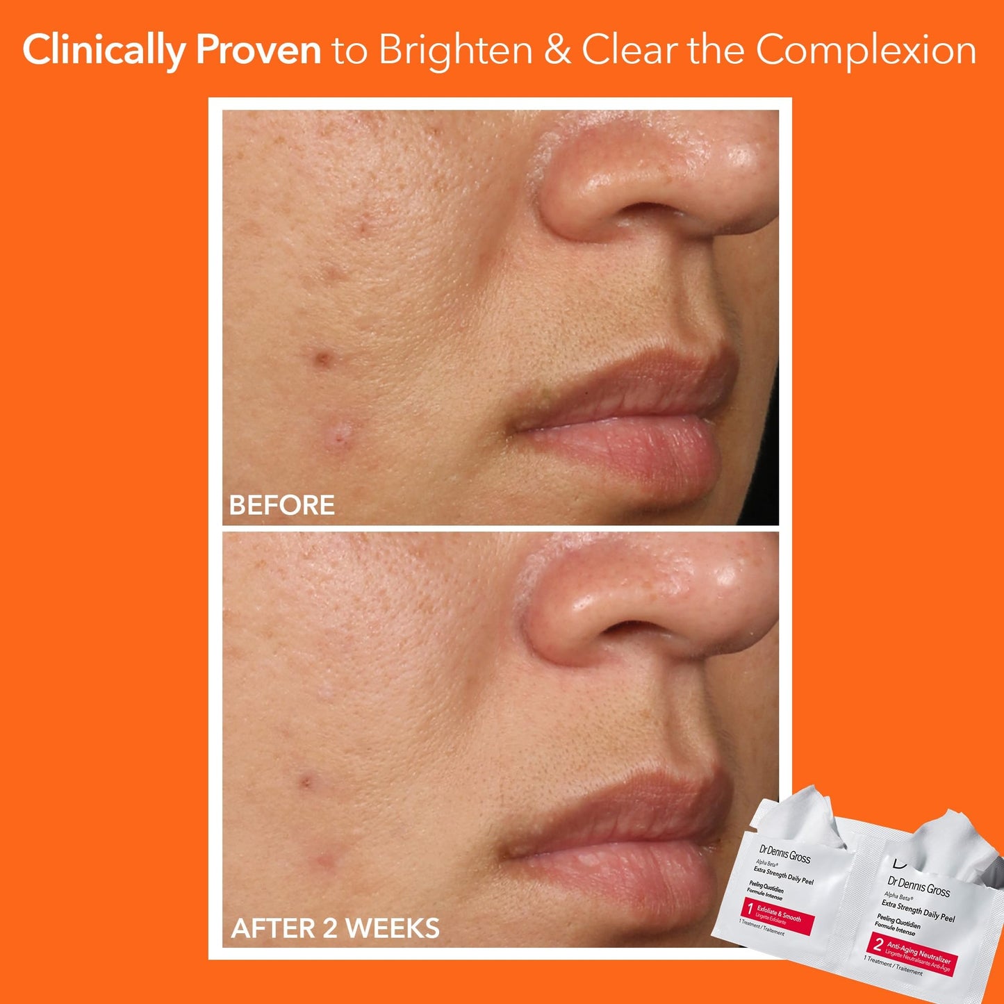 Dr. Dennis Gross Alpha Beta Extra Strength Daily Peel - 2-Step Exfoliating Pads for Enhanced Anti-Aging, Smoother Skin, and Radiant Complexion, 5 Beauty & Personal Care Dr Dennis Gross