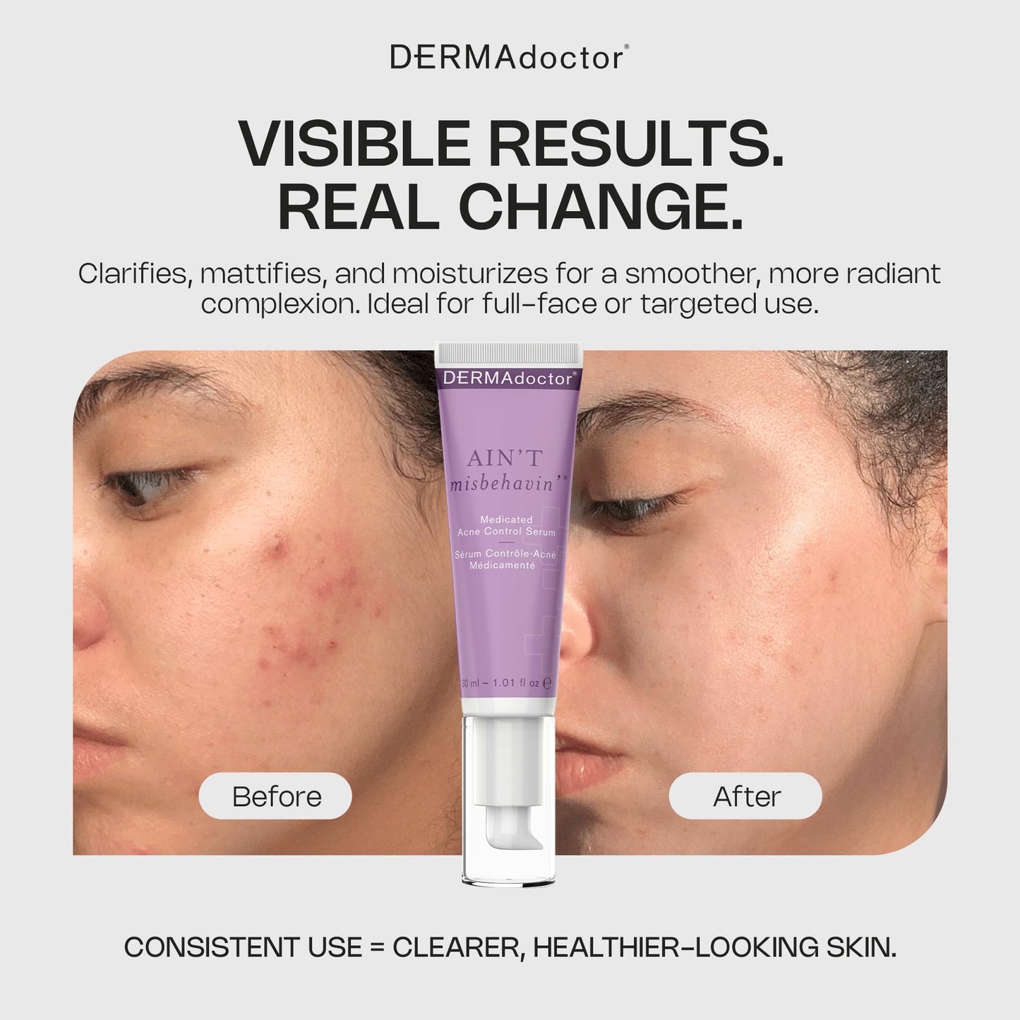 DERMAdoctor Ain't Misbehavin' Dermatologist Formulated Salicylic Acid Acne Control Serum, Acne Spot Treatment for Blemish Control and Cystic Acne Beauty & Personal Care DERMAdoctor