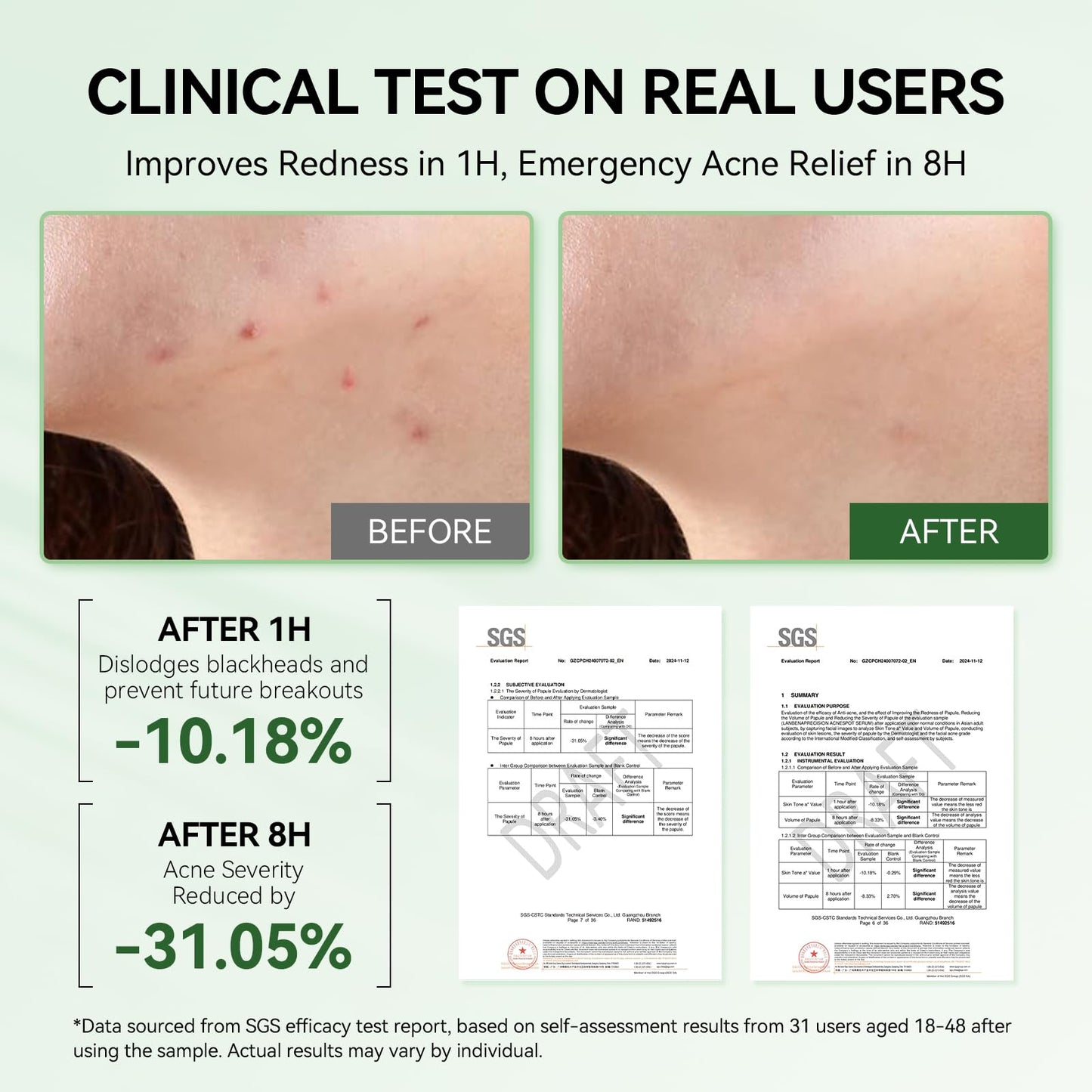 LANBENA 2% Salicylic Acid Spot Serum, 8H Rapid Acne Treatment for Acne-Prone Sensitive Skin, Fast-Acting Dry Out Pimples, Fade Acne Marks, Redness Beauty & Personal Care LANBENA