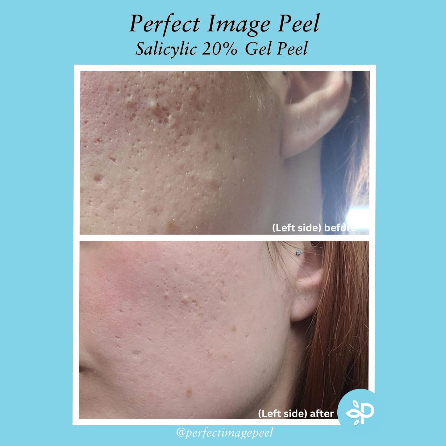 Salicylic Gel Chemical Peel - Enhanced with Green Tea Extract and Tea Tree Oil (20% Strength) Beauty & Personal Care Perfect Image