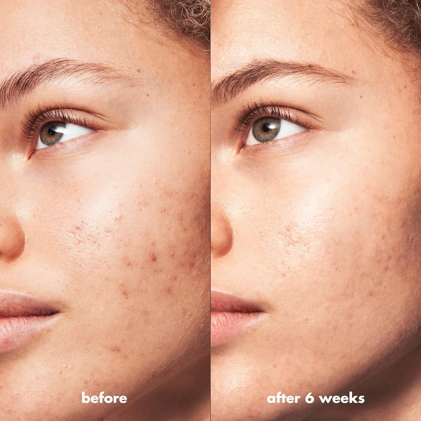 e.l.f. SKIN Blemish Breakthrough Calming Water Cream, Lightweight Blemish-Fighting Face Moisturiser, Prevents New Blemishes & Calms Skin Beauty & Personal Care e.l.f.