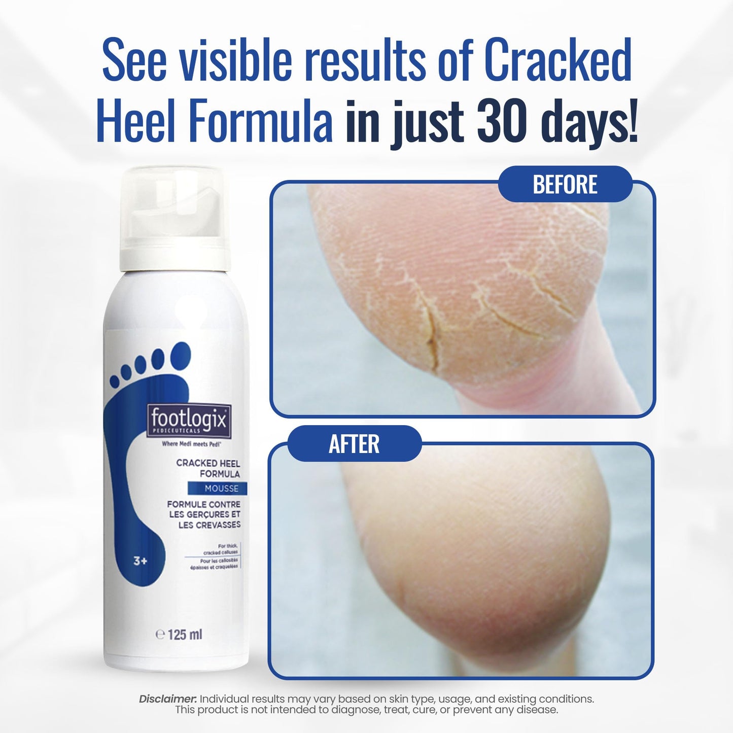 FOOTLOGIX Cracked Heel Formula, White 4.23 Ounce Beauty & Personal Care FOOTLOGIX