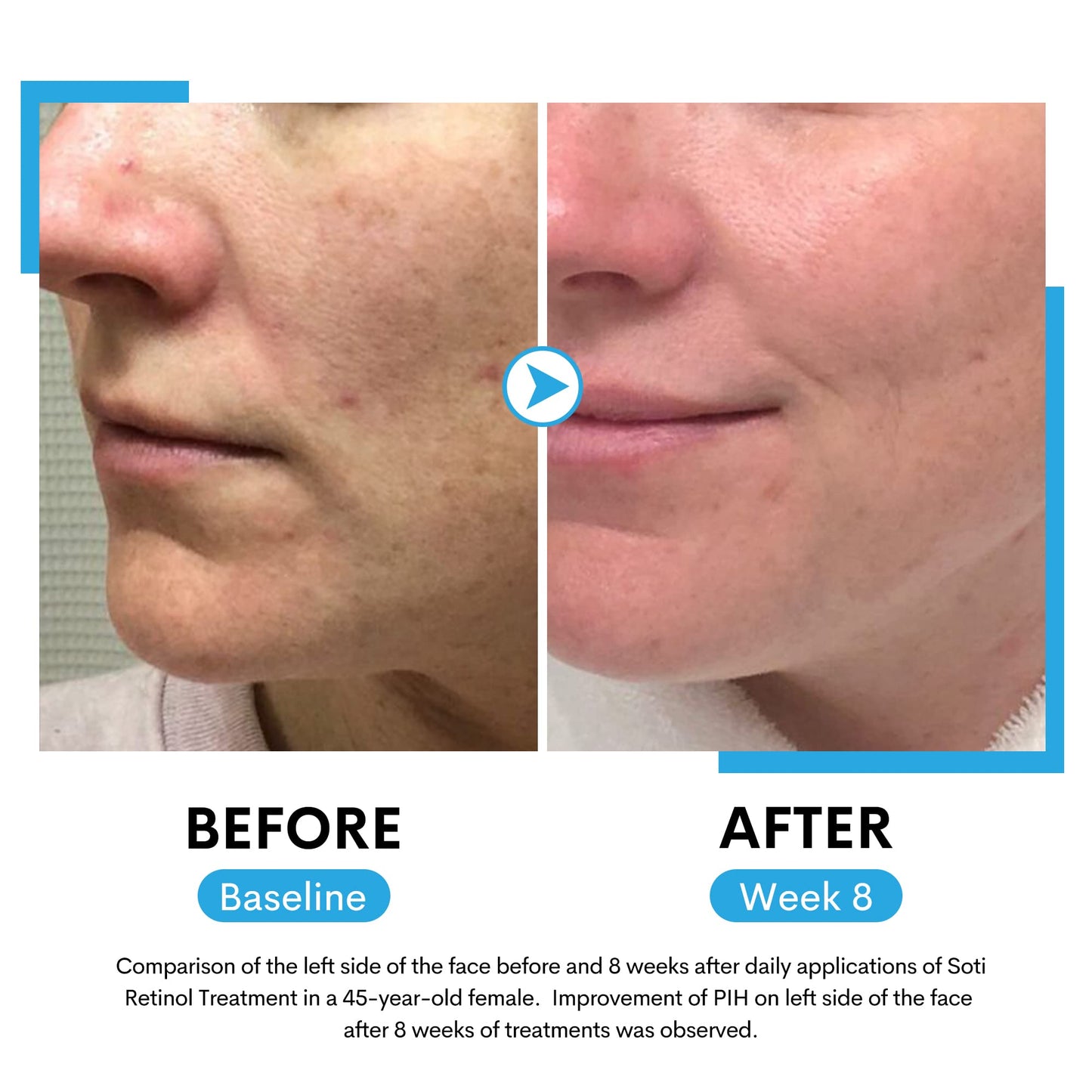 Retinol Face Serum, Reduces Wrinkles, Age Spots, Post-Acne Marks. Stimulates Collagen, Firm Skin, Anti Aging with Hyaluronic Acid, Niacinamide (30ml) Beauty & Personal Care Soti