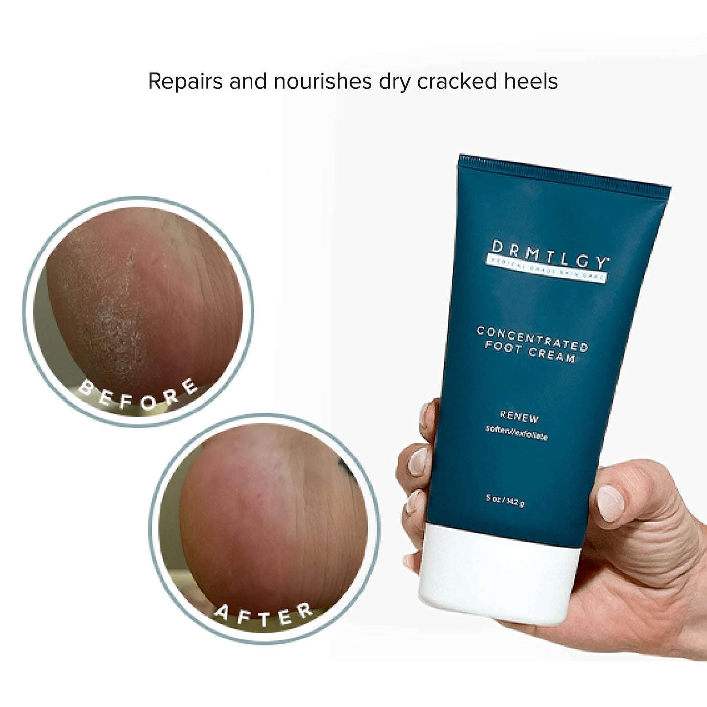 DRMTLGY Concentrated Foot Cream for Dry Cracked Heels - Heel Cream & Foot Lotion for Dry Cracked Feet -Dry Feet Treatment for Women & Men Beauty & Personal Care DRMTLGY