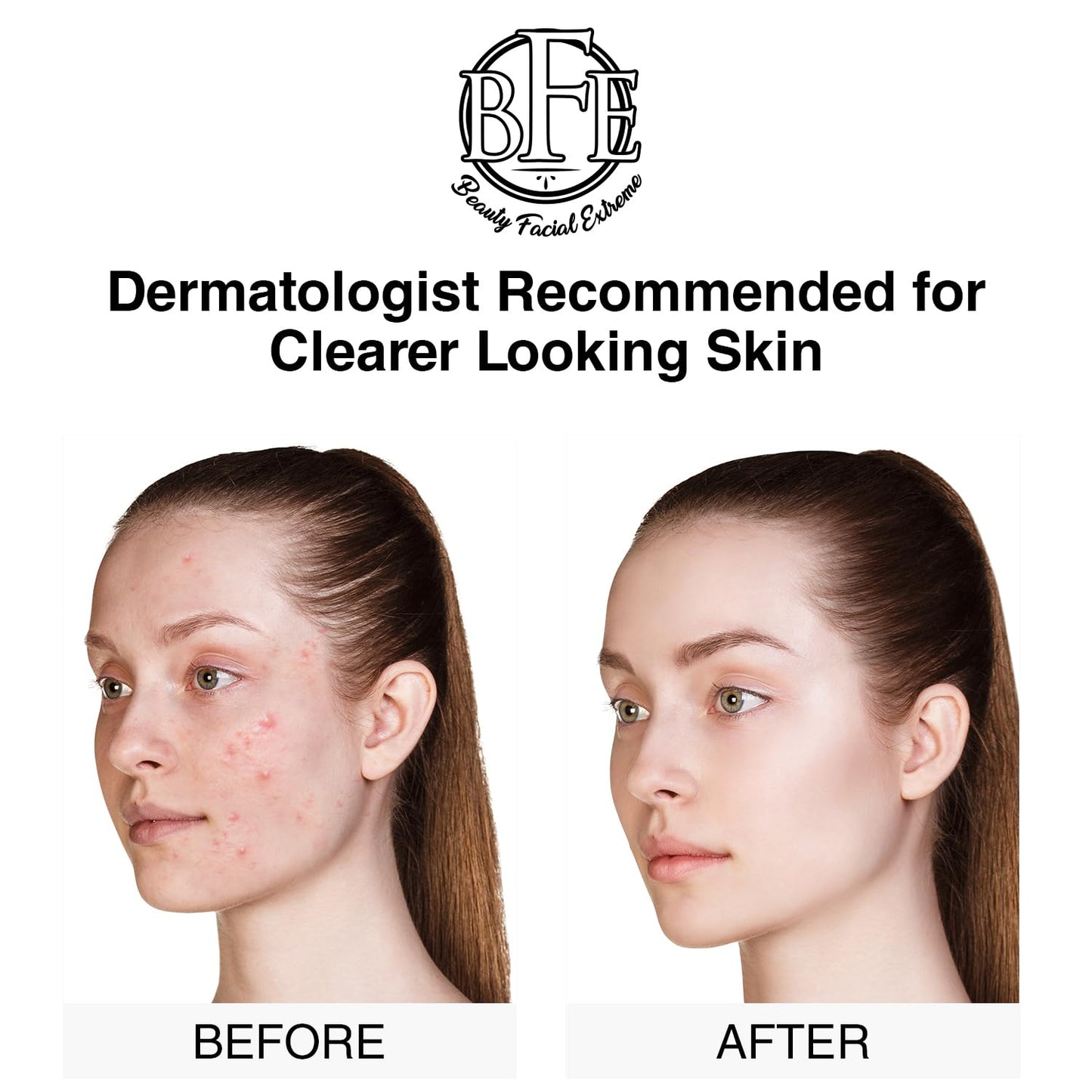 Acne Treatment Pads- Eliminates Cystic Breakouts, Oily Skin & Clogged Pores. Clear Pimple, Whitehead, Blackhead, Dark Spots & Improve Skin Texture. Beauty & Personal Care Beauty Facial Extreme