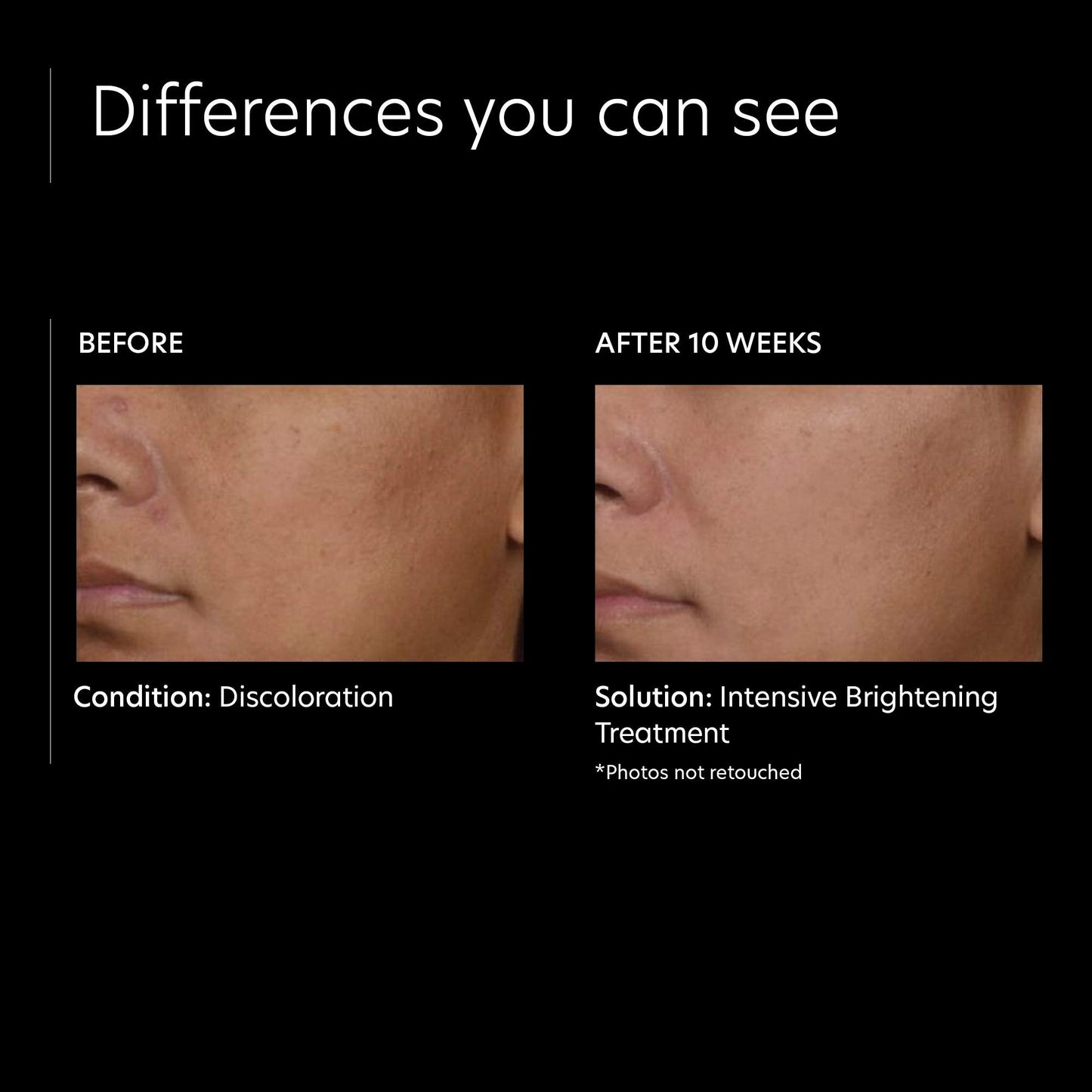 PCA SKIN Intensive Brightening Treatment - 0.5% Pure Vitamin A Retinol Face Serum for Discoloration & Dark Spots (1 oz) Beauty & Personal Care PCA SKIN