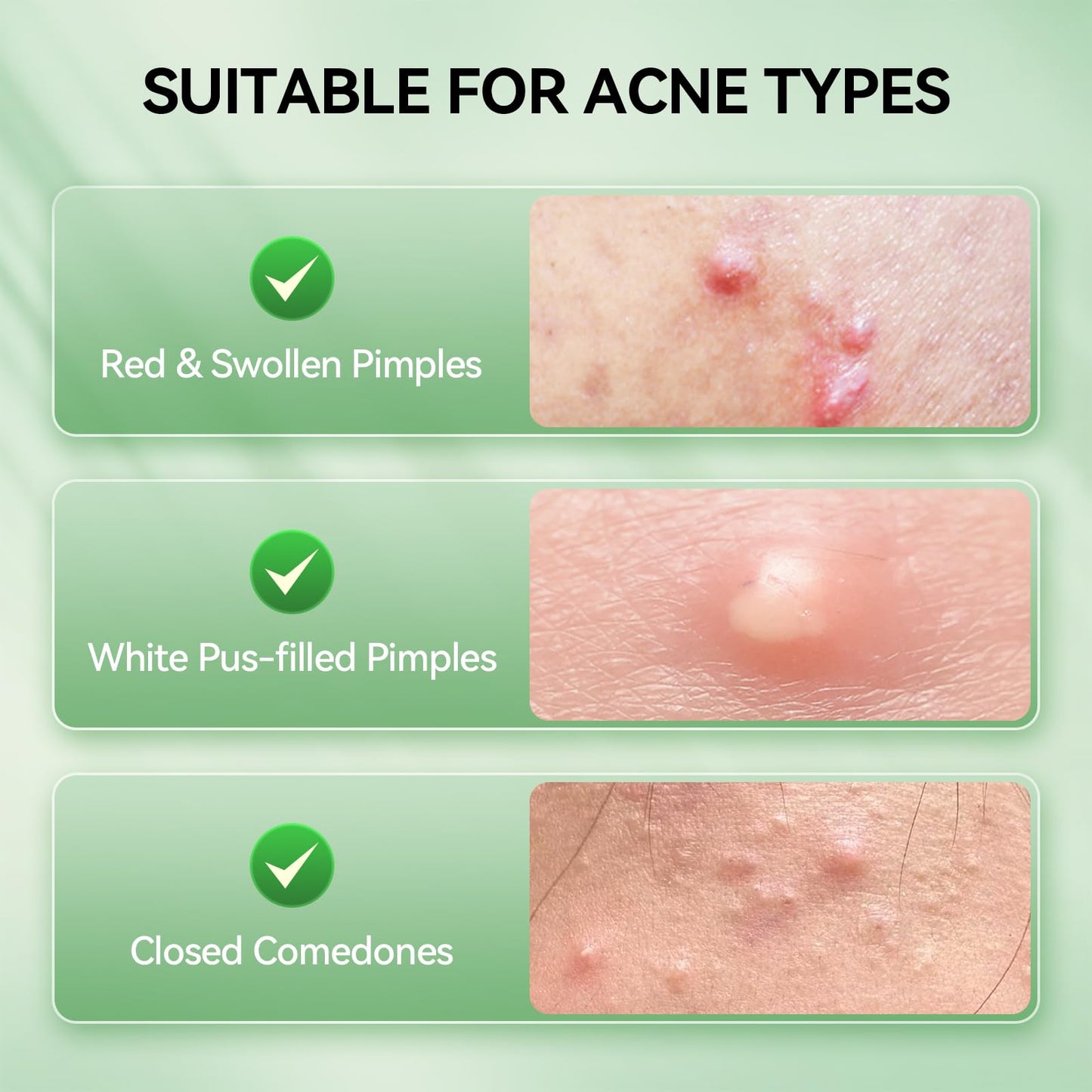 LANBENA 2% Salicylic Acid Spot Serum, 8H Rapid Acne Treatment for Acne-Prone Sensitive Skin, Fast-Acting Dry Out Pimples, Fade Acne Marks, Redness Beauty & Personal Care LANBENA