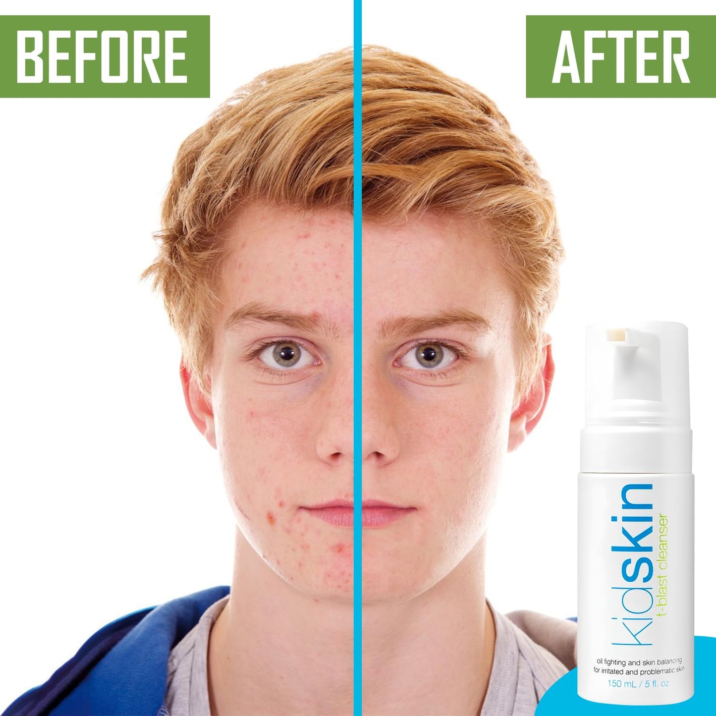 Kidskin T-Blast Facial Cleanser, Gentle Face Wash with Tea Tree Oil, Spot Skin Care for Kids and Teens, Non-Drying Natural Cleanser for Oily or Dry Beauty & Personal Care Kidskin
