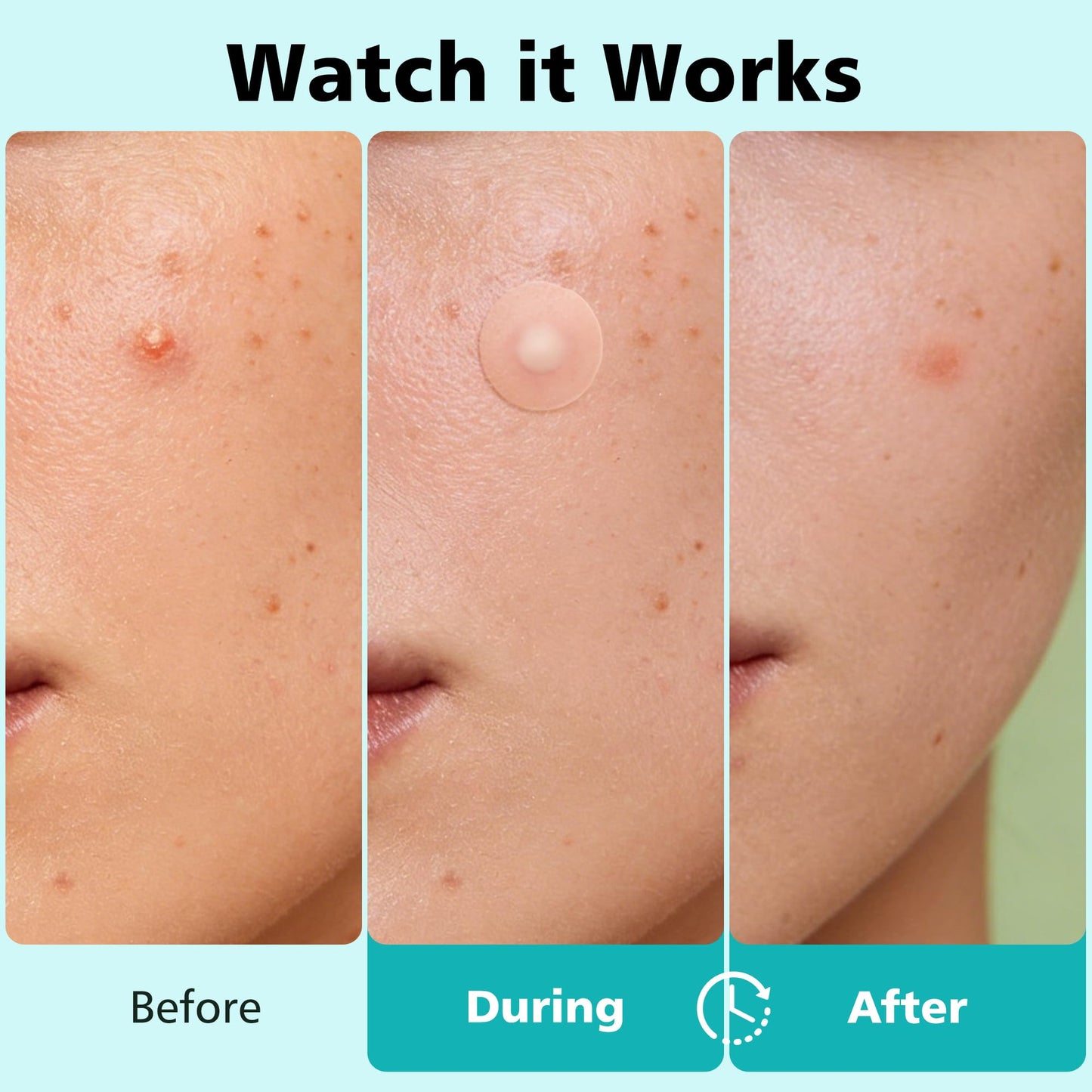 Dr.patch Pimple Patches for Face - 4 Size 600 Counts Acne Patches, Hydrocolloid Patches for Covering Zits and Blemishes, Spot Stickers with Salicylic Beauty & Personal Care Dr.patch
