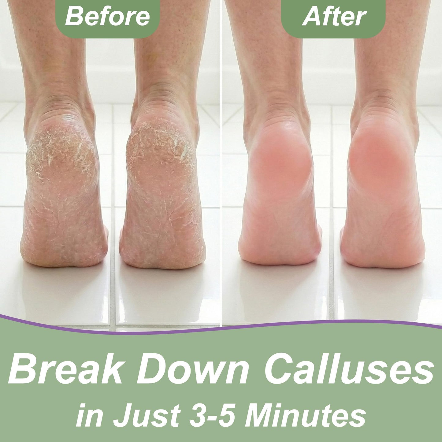 Dr. Entre's Callus Remover Gel & Foot File: Extra Strength Callus Remover for Feet, Foot Callus Remover Care, Pedicure Tools Supplies, Spa Kit, Dead Beauty and Personal Care EntreFeet