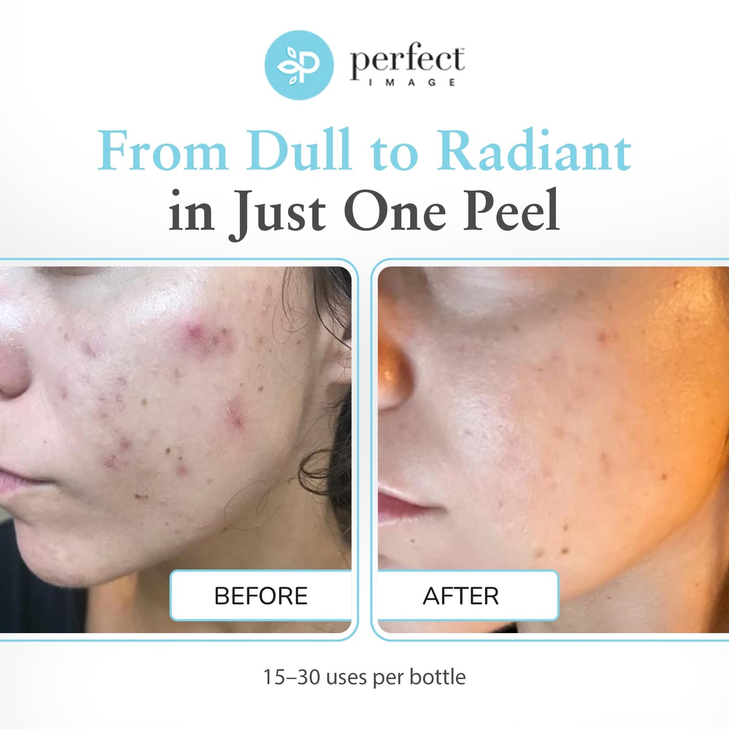 Glycolic Acid 30% Gel Peel - Enhanced with Retinol and Green Tea Extract (Professional Chemical Peel)- 1 fl oz 30mL Beauty & Personal Care Perfect Image