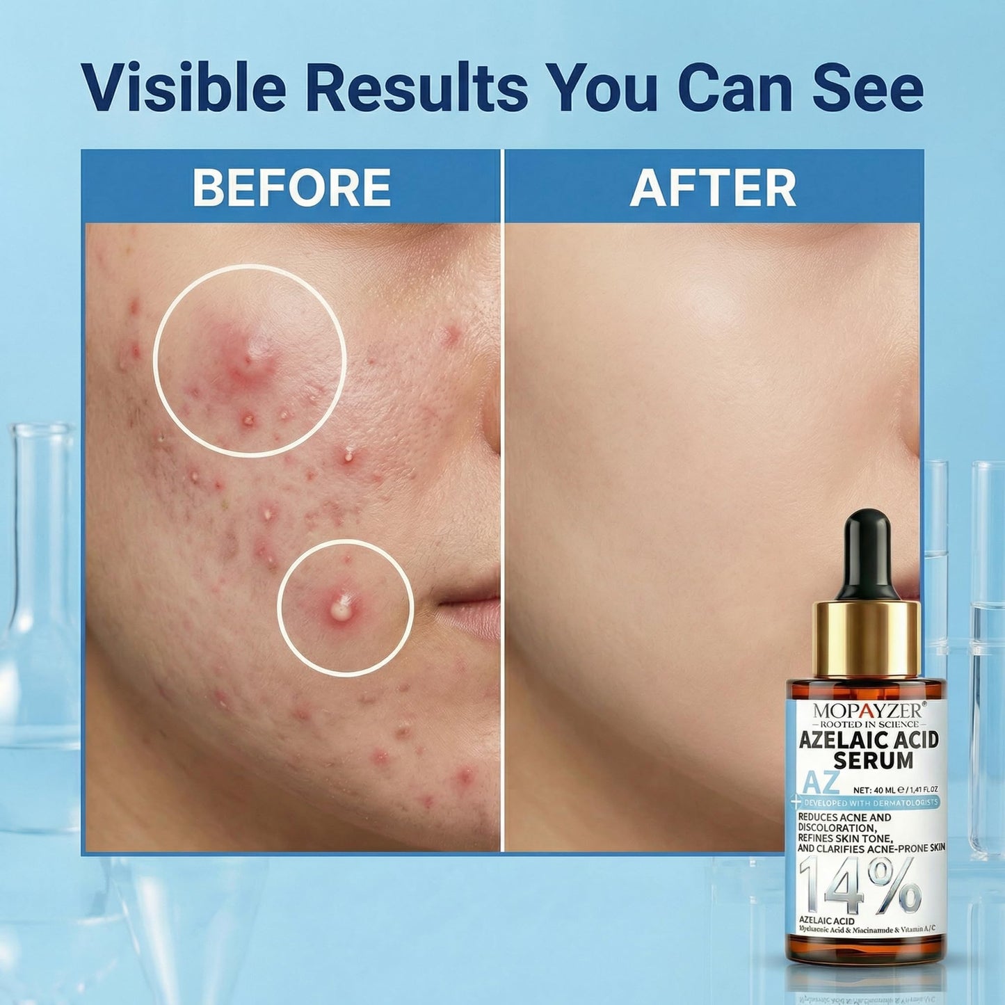 14% Azelaic Acid Serum for Face with Niacinamide, Hyaluronic Acid & Vitamin A/C - Redness Soothing, Acne & Dark Spot Care, Azelic Acid for Acne Beauty & Personal Care mopayzer