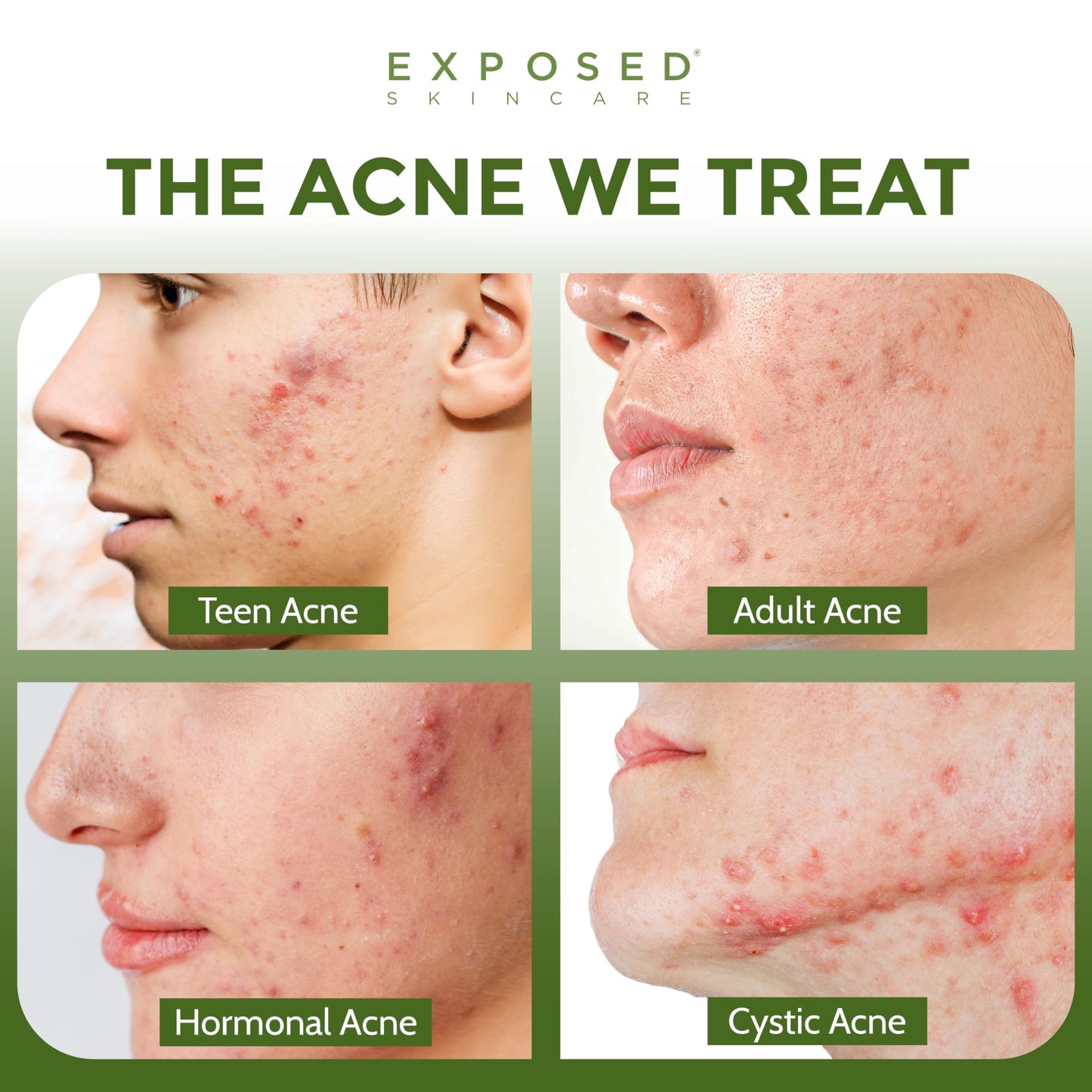 Exposed Skin Care, Clear Pore Serum with 1% Salicylic Acid for Sensitive and Oily Skin - Gently Clears Blackheads, Minimizes Pores and Reduces Excess Beauty & Personal Care Exposed Skin Care
