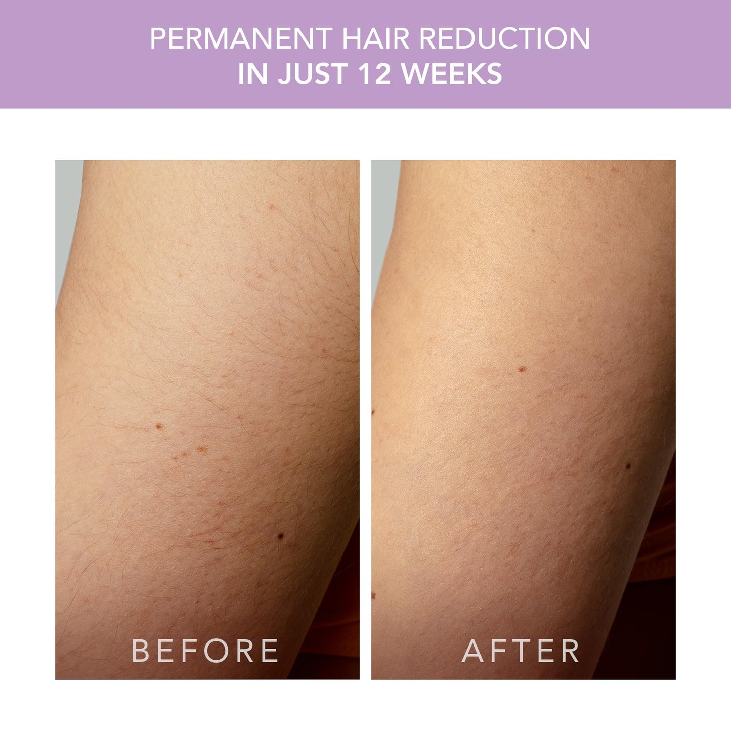 FOREO Peach 2 go IPL Hair Removal Device - Travel-Friendly Permanent Removal - Laser Treatment for Body & Face - Painless & Skin Cooling - Silicone Beauty and Personal Care FOREO