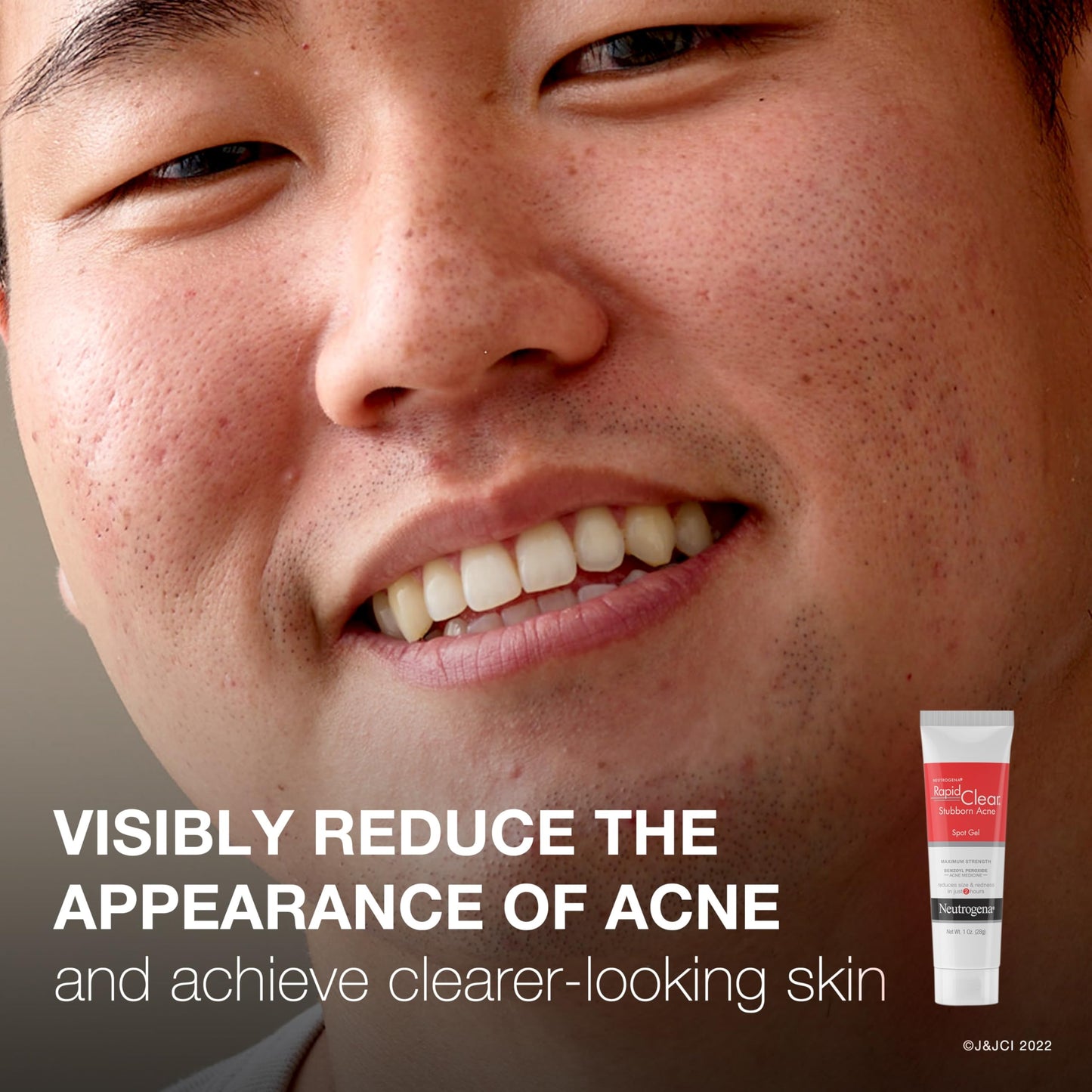 Neutrogena Rapid Clear Stubborn Acne Spot Treatment Gel with Maximum Strength 10% Benzoyl Peroxide Acne Treatment Medication, Pimple Cream for Acne Beauty & Personal Care Neutrogena