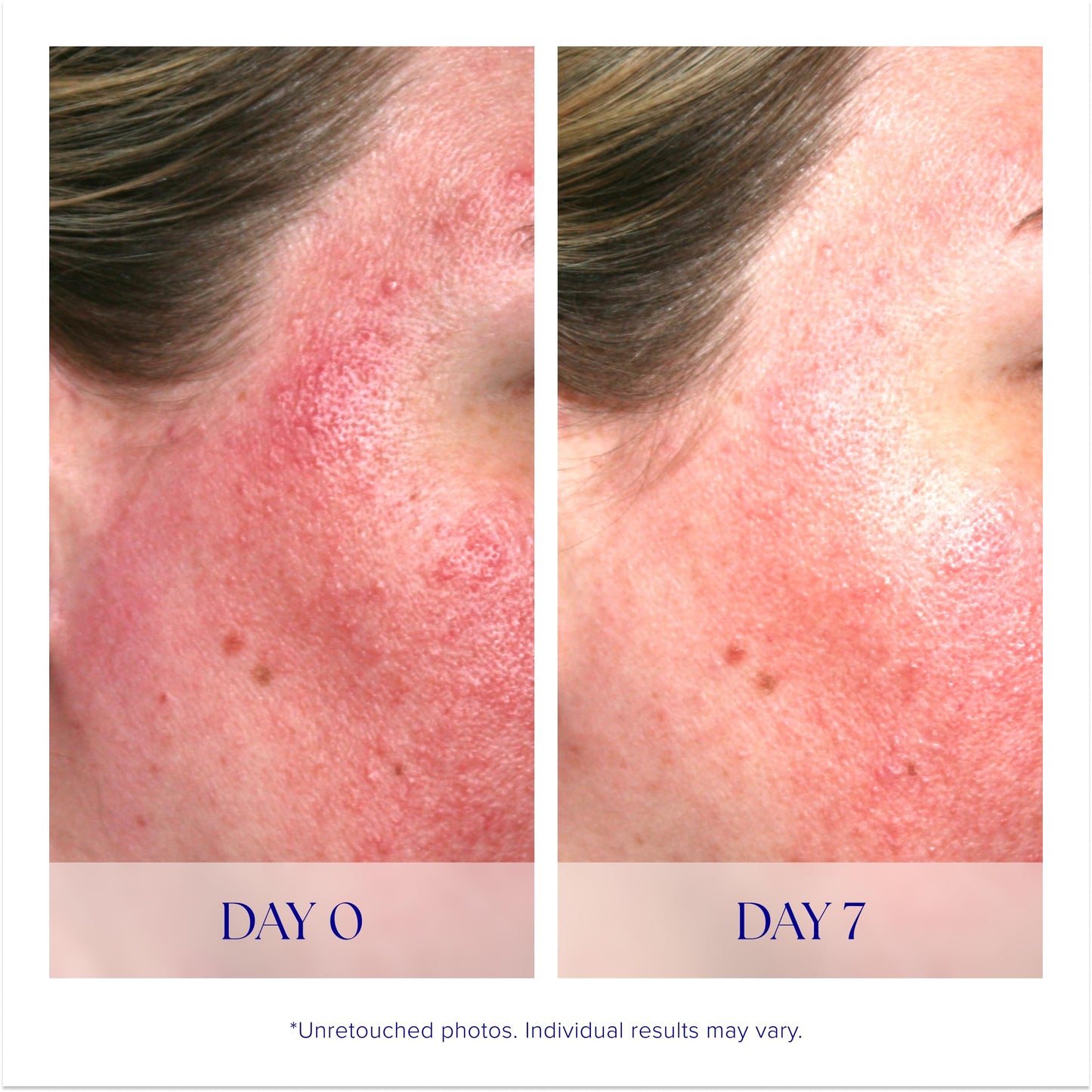 iS Clinical Pro-Heal Serum Advance+ antioxidant-rich serum containing vitamin C, E, and A for redness, rosacea, inflammation, 0.5 Fl Oz Beauty & Personal Care iS CLINICAL