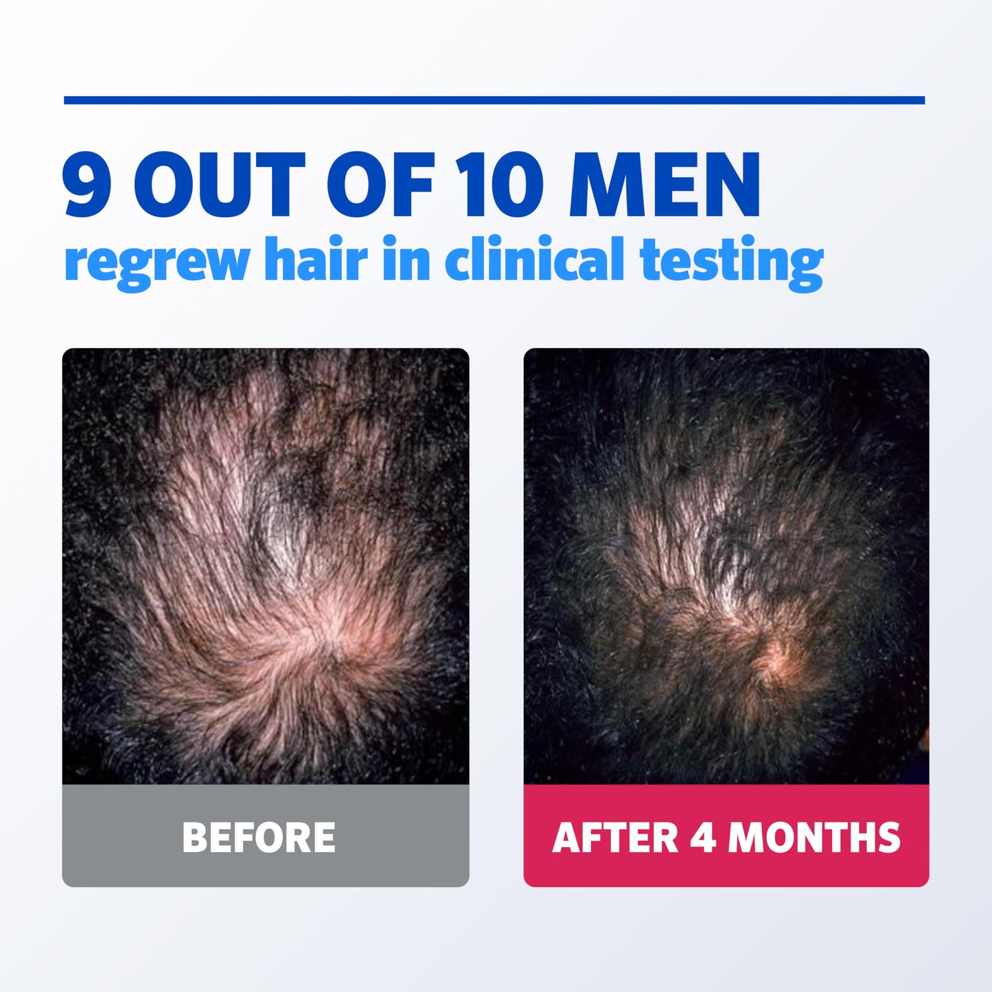Men's Rogaine 5% Minoxidil Foam for Hair Regrowth, Topical Hair Loss Treatment for Men to Regrow Fuller, Thicker Hair, Unscented Minoxidil Topical Beauty and Personal Care Rogaine