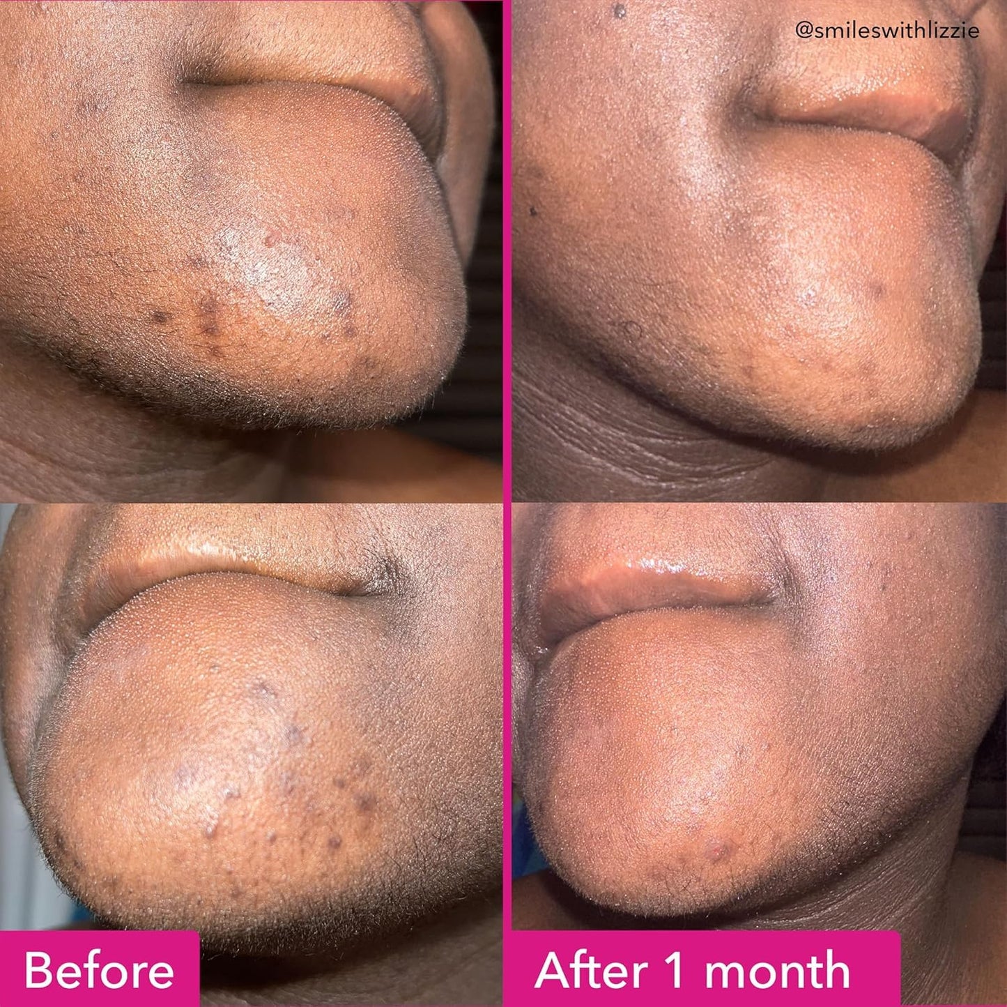 Good Molecules Brightening & Dark Spots Bar - Soap Free Face and Body Bar - Tranexamic, Kojic Acids and Niacinamide to Target Dark Spots - Skin Care Beauty and Personal Care Good Molecules