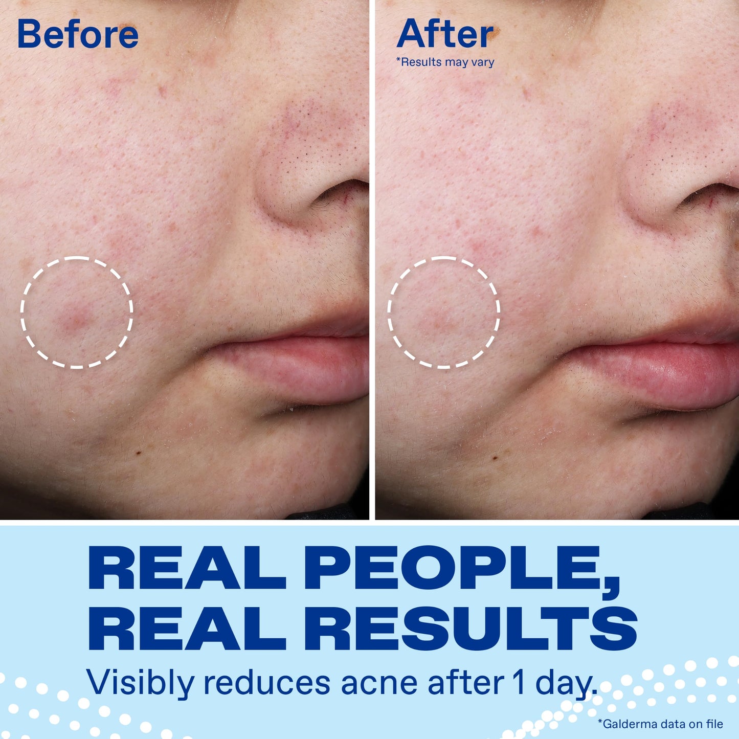 Differin Acne Spot Treatment, Max Strength, 10% Benzoyl Peroxide, 1 fl oz Beauty and Personal Care Differin
