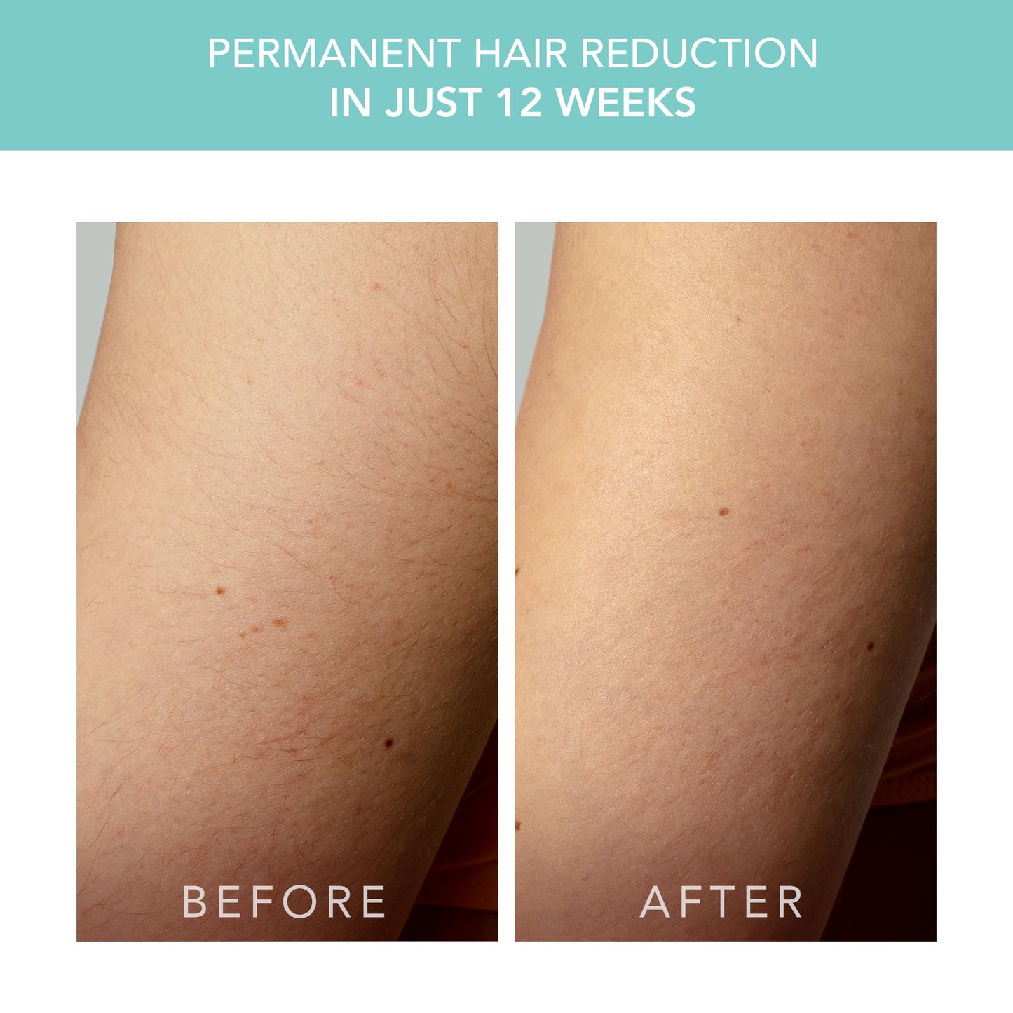 FOREO Peach 2 go IPL Hair Removal Device - Travel-Friendly Permanent Hair Removal - Laser Hair Removal - Body & Face - Painless Hair Removal - Skin Beauty and Personal Care FOREO