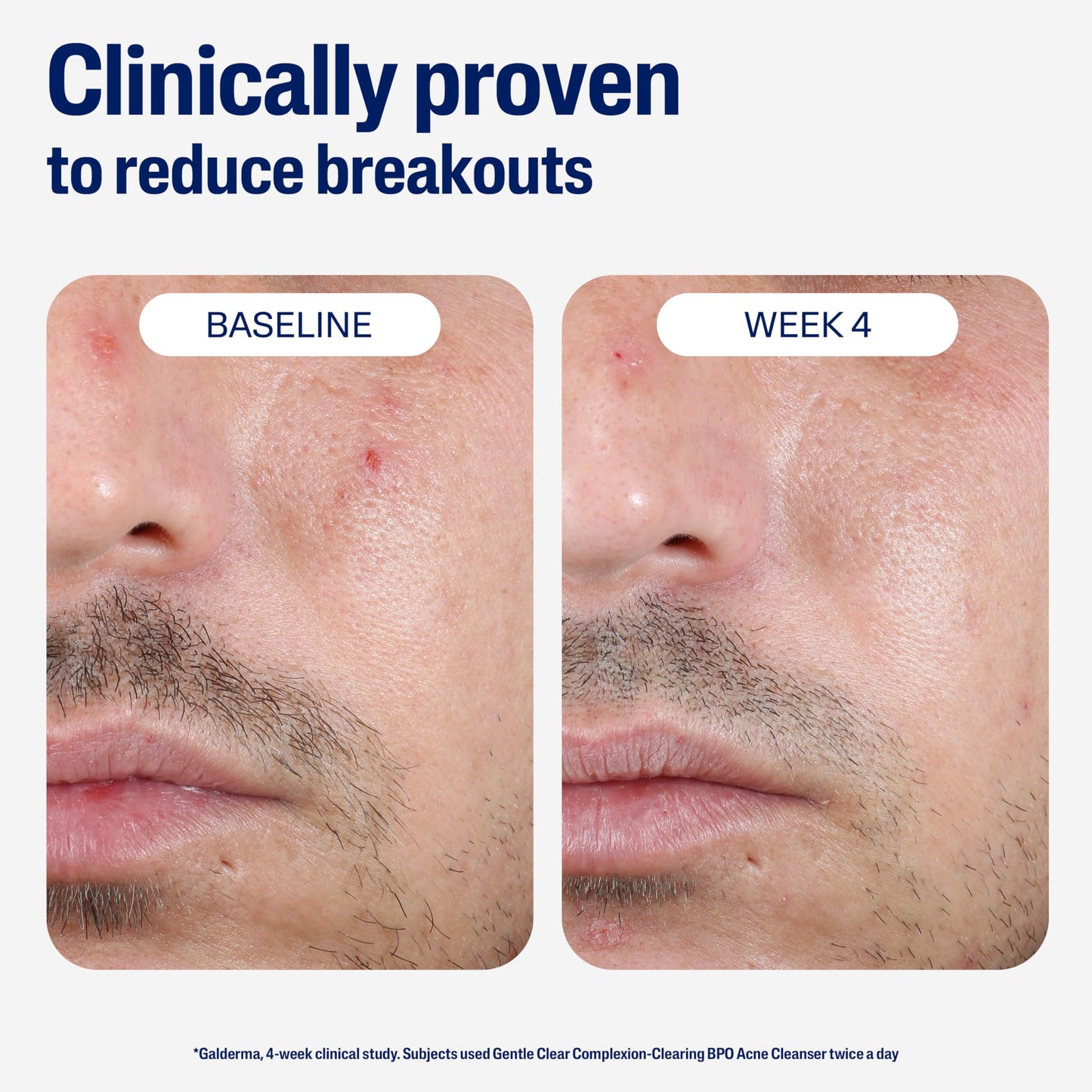 Cetaphil Gentle Clear Complexion-Clearing BPO Acne Cleanser with 2.6% Benzoyl Peroxide, Creamy and Soothing for Sensitive Skin, Suitable for All Skin Beauty & Personal Care Cetaphil