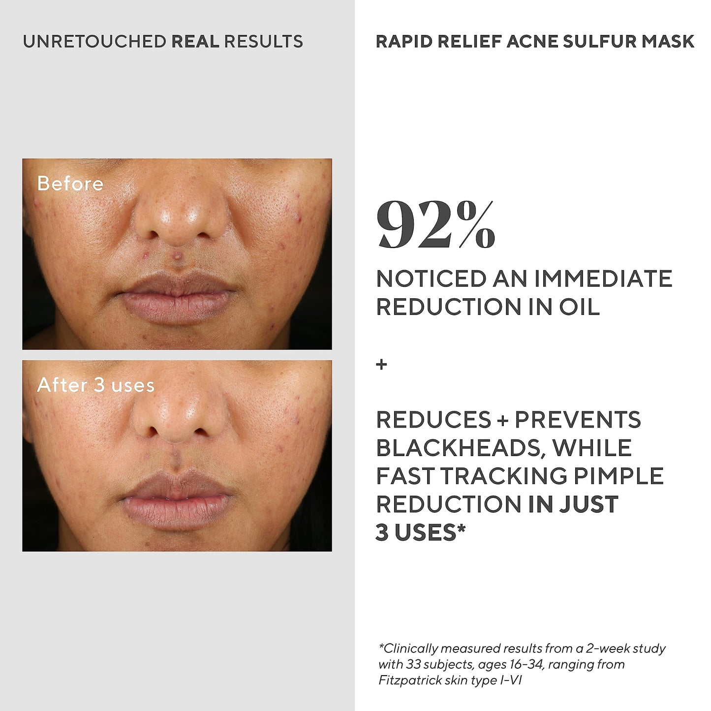 Murad Rapid Relief Acne Sulfur Mask - Clay Mask with Salicylic Acid, 5% Sulfur, and Austrian Peat Reduces Oil, Minimizes Breakouts, Reduces Pimple Beauty & Personal Care Murad