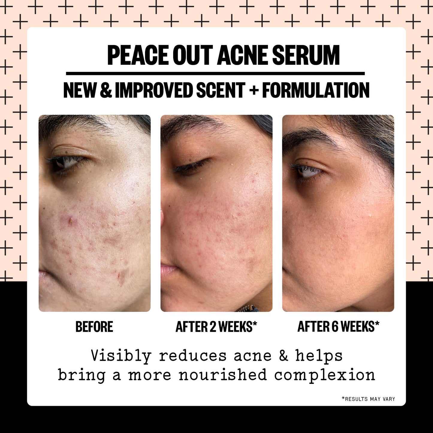 PEACE OUT Skincare Acne Serum. Daily Multi-Benefit Face Serum with 2% Salicylic Acid to Target Pimples, Zits, Blemishes and Breakouts Beauty & Personal Care PEACE OUT