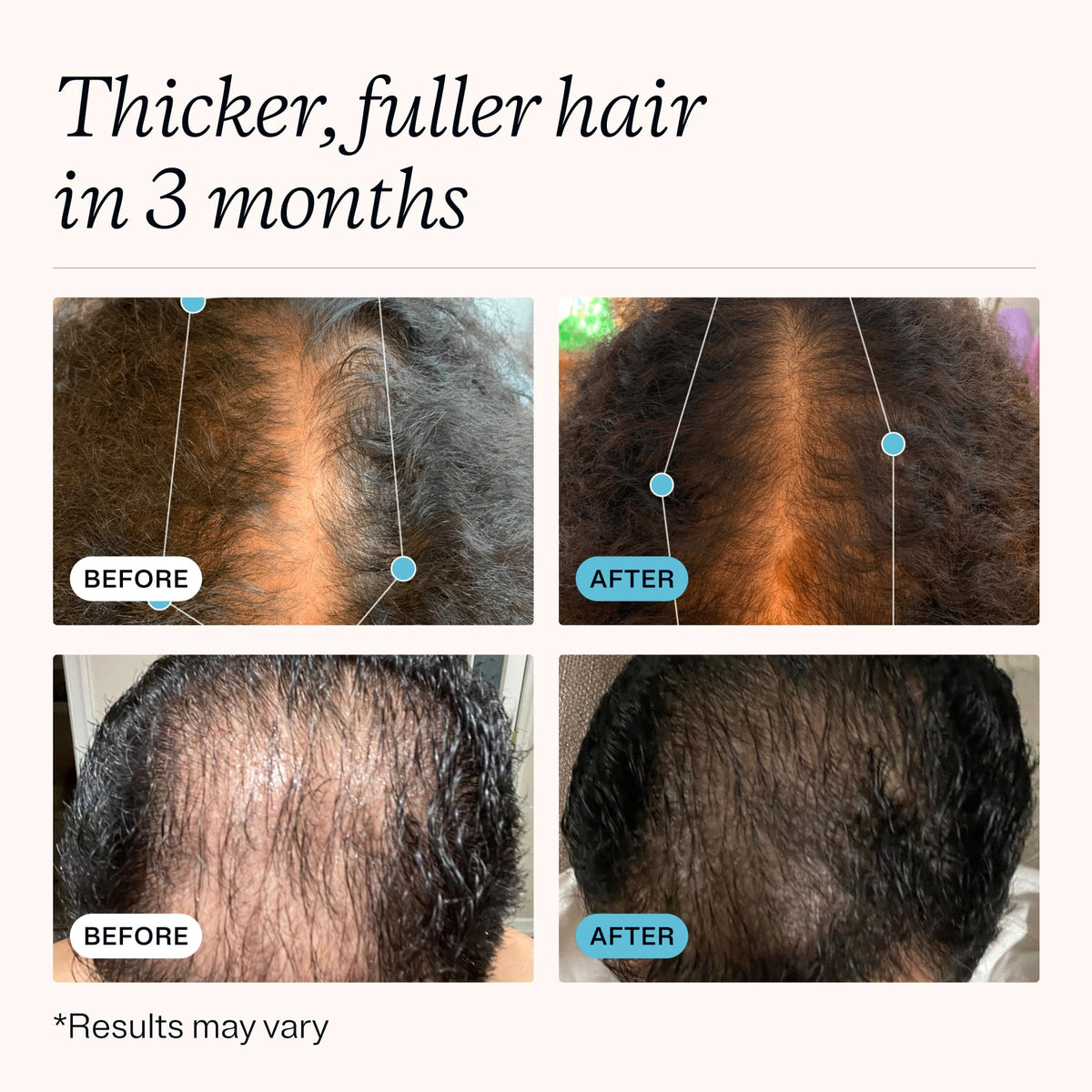 MDhair Regrowth Serum - Hair Growth Serum for Thinning Hair, Women & Men