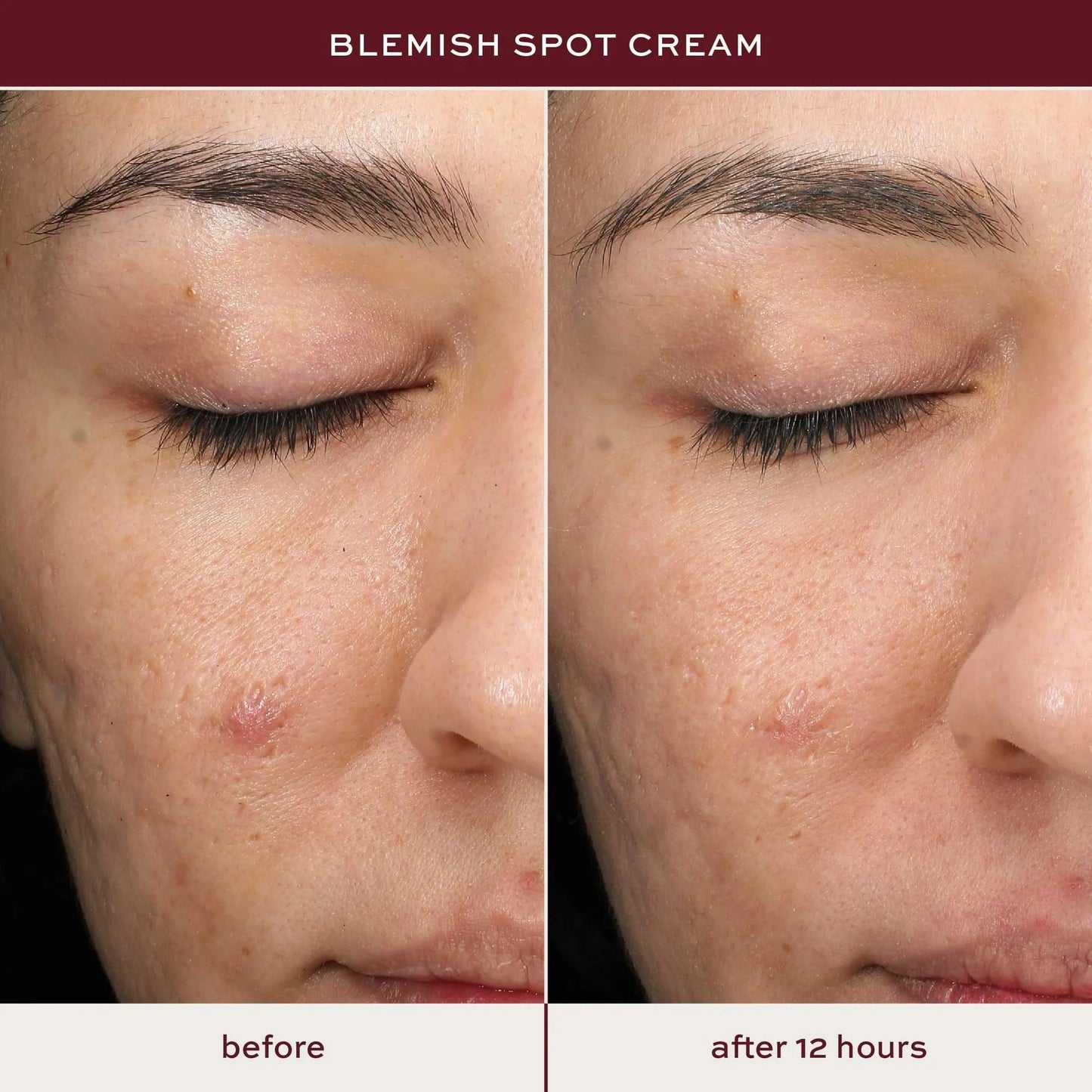 ITK Skincare Salicylic Acid Acne Spot Treatment for Face, Back & Body - Fast Active Acne Relief - Pimple Cream for Acne Prone Skin - Clear Blemishes Beauty & Personal Care ITK