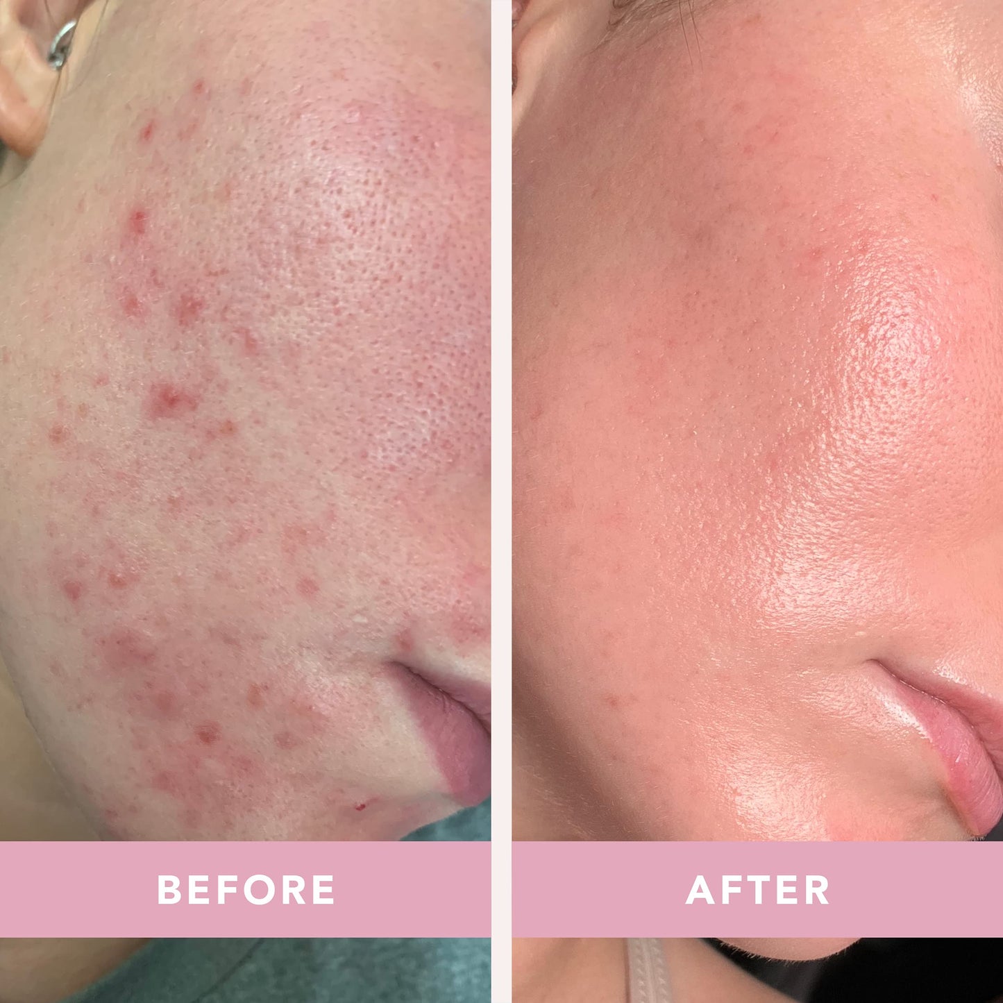 Doll 10 - Smooth Assist Overnight Facial 11% Triple-Acid Resurfacing Serum - Proven Overnight Transformation - Improves Skin Tone, Pores, Wrinkles Beauty & Personal Care DOLL 10