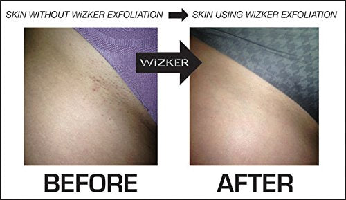 WIZKER® Premium Ingrown Hair Exfoliating Brush: Soft + Firm Face Body Scrubber, Sensitive Skin Exfoliator, Prevents Razor Bumps, Shave, Laser, Wax Beauty & Personal Care WIZKER