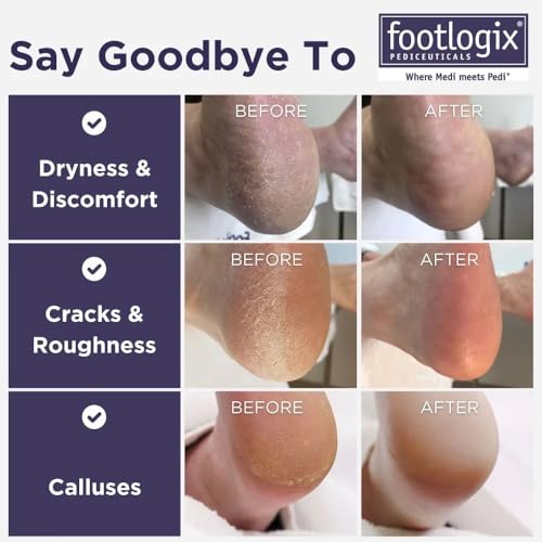Foot Care Callus Softener - Footlogix Callus Softener Spray & Double Sided Foot File Set for Dry, Rough, Cracked Heel - Feet Exfoliator & Scrubber Beauty & Personal Care FOOTLOGIX