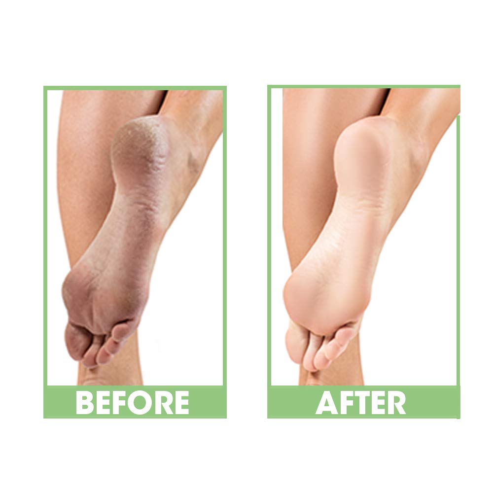 ProLinc Dry Heel Eliminator | Protect And Hydrate Dry Heels And Feet | Fast Absorbing And Non Greasy | Made In The USA | 4 Fl. Oz. Beauty & Personal Care ProLinc