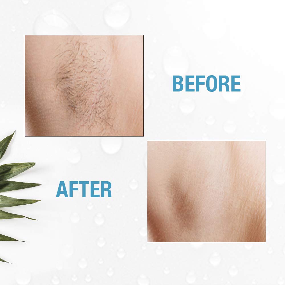 Clean + Easy Electrolysis Machine for Permanent Hair Removal - Non-Laser, Painless Electrolysis Hair Removal for Face & Body, At-Home Remover Device Beauty & Personal Care Clean + Easy