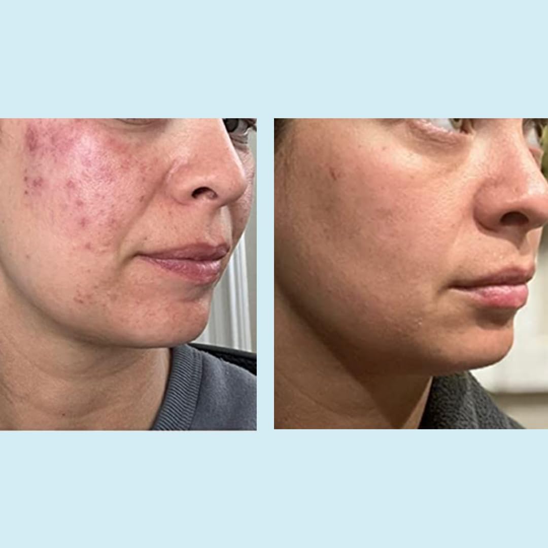 Glycolic Gel Peel - Enhanced with Retinol and Green Tea Extract (70% Strength) Beauty & Personal Care Perfect Image