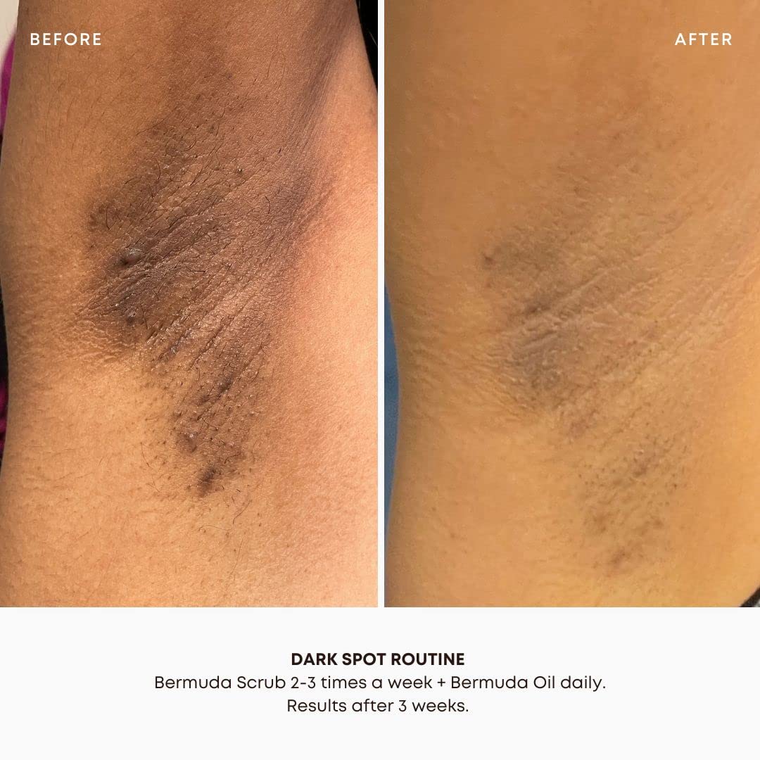 Bushbalm Dark Spots and Ingrown Hair 2 Step Routine - Rejuvenate and Nourish - Ingrown Hair Oil (30 ml) and Exfoliating Scrub (236 ml) - Bermuda Beauty & Personal Care Bushbalm