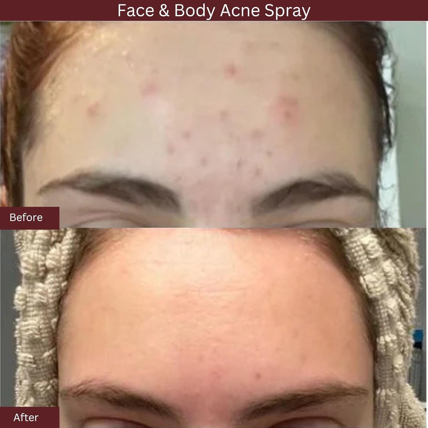 ITK Skincare 2% Salicylic Acid Spray for Face & Body Acne - Blemish-Fighting Treatment for Body Acne, Bacne, Blackheads, Pimples & Blemishes - BHA Beauty & Personal Care ITK