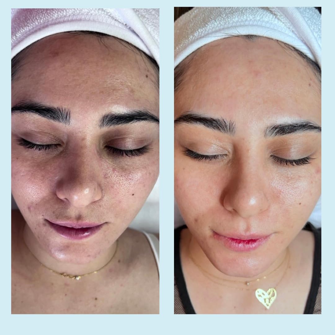 Salicylic Gel Chemical Peel - Enhanced with Green Tea Extract and Tea Tree Oil (20% Strength) Beauty & Personal Care Perfect Image