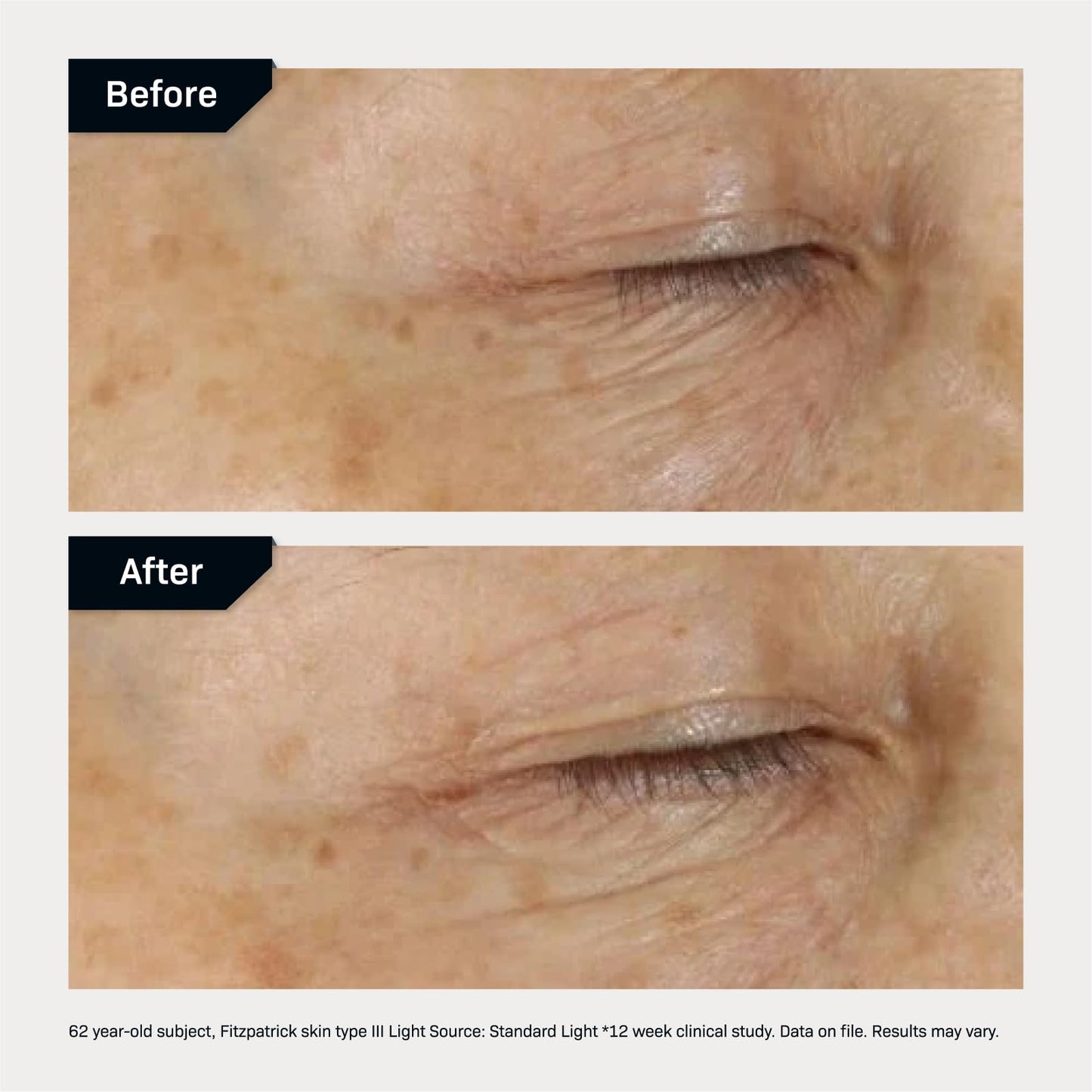 Revision Skincare D·E·J Eye Cream®, Clinically Proven to Reduce Under-Eye Fine Lines and Wrinkles with Peptides and Hyaluronic Acid for a Firmer Beauty & Personal Care Revision Skincare