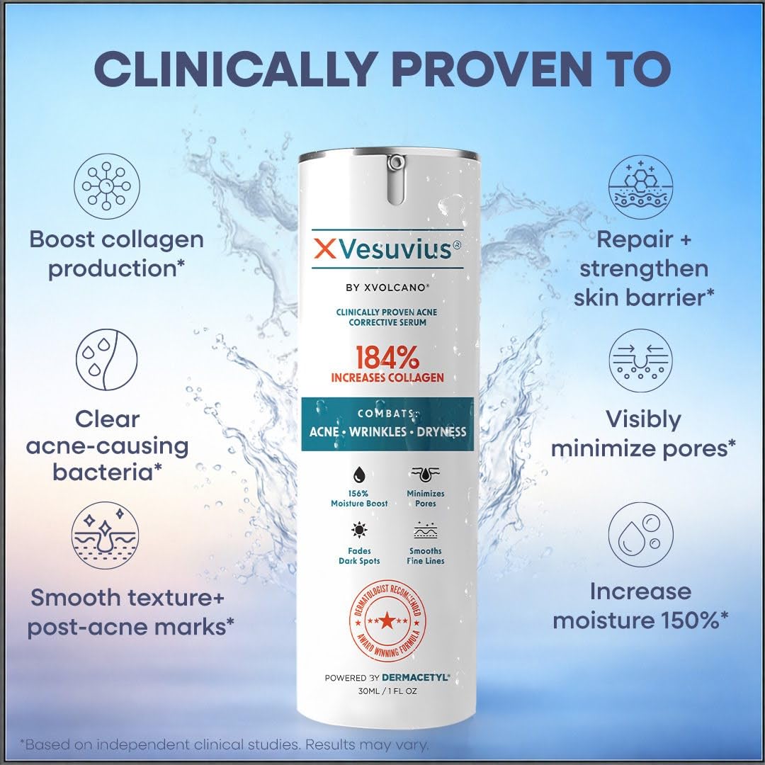 XVesuvius Acne Treatment Serum - Clinical Strength Formula with 2% Salicylic Acid & Retinol - Clears Breakouts, Fades Scars, Anti-Aging - 30ml (1 Beauty & Personal Care xvolcano
