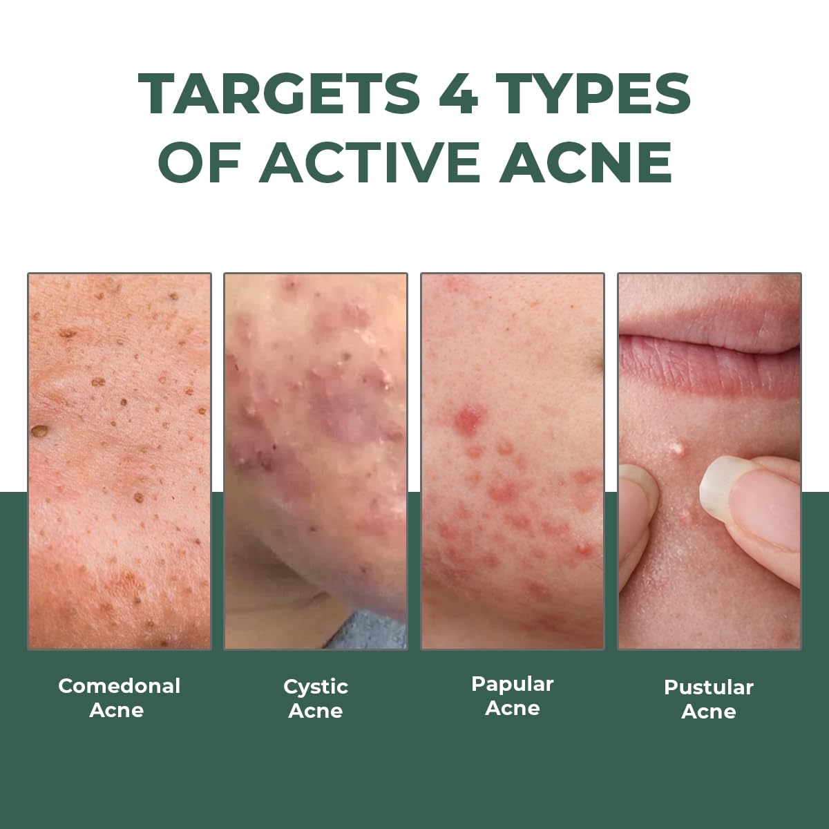 Acne Spot Corrector Gel Serum Beauty & Personal Care Conscious Chemist