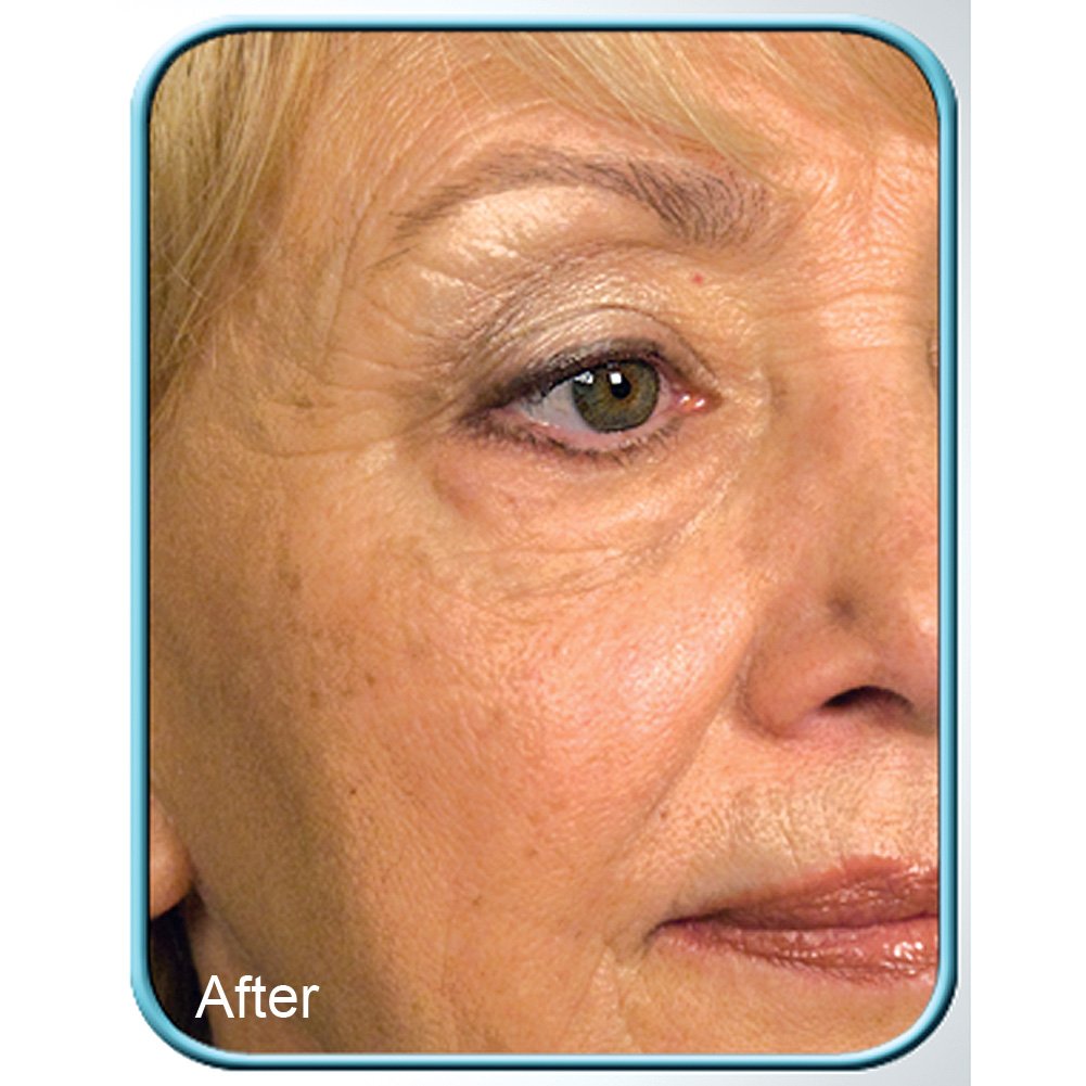 Biologic Stem Cell Therapy (Set of 4 Jars) for Deep Wrinkles - by BioLogic Beauty & Personal Care Biologic Solutions