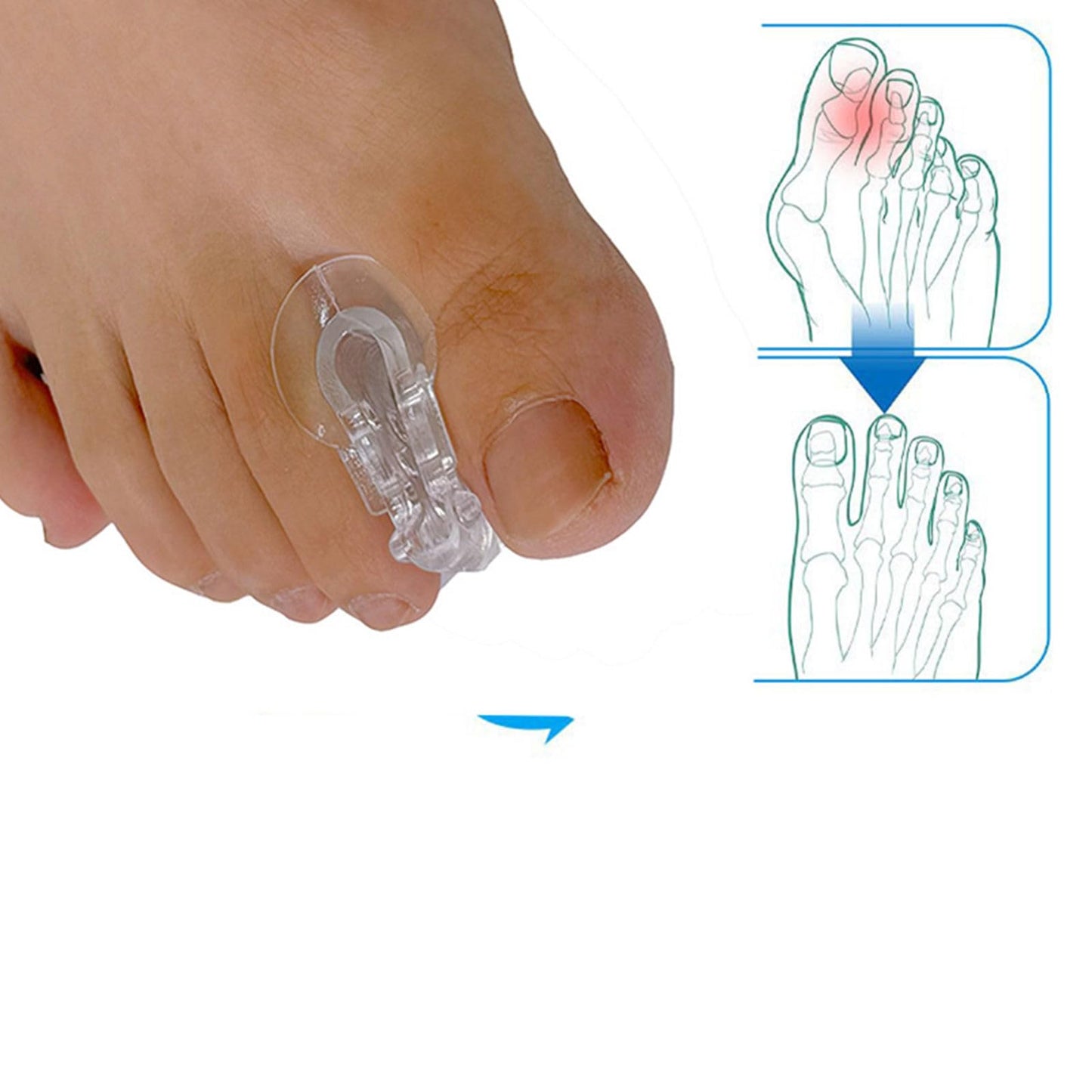2PCS Soft&Breathable Big Toe Orthotic Pad L/R Feet Prevent Toe Overlap NEW Beauty and Personal Care ZEZEFUFU
